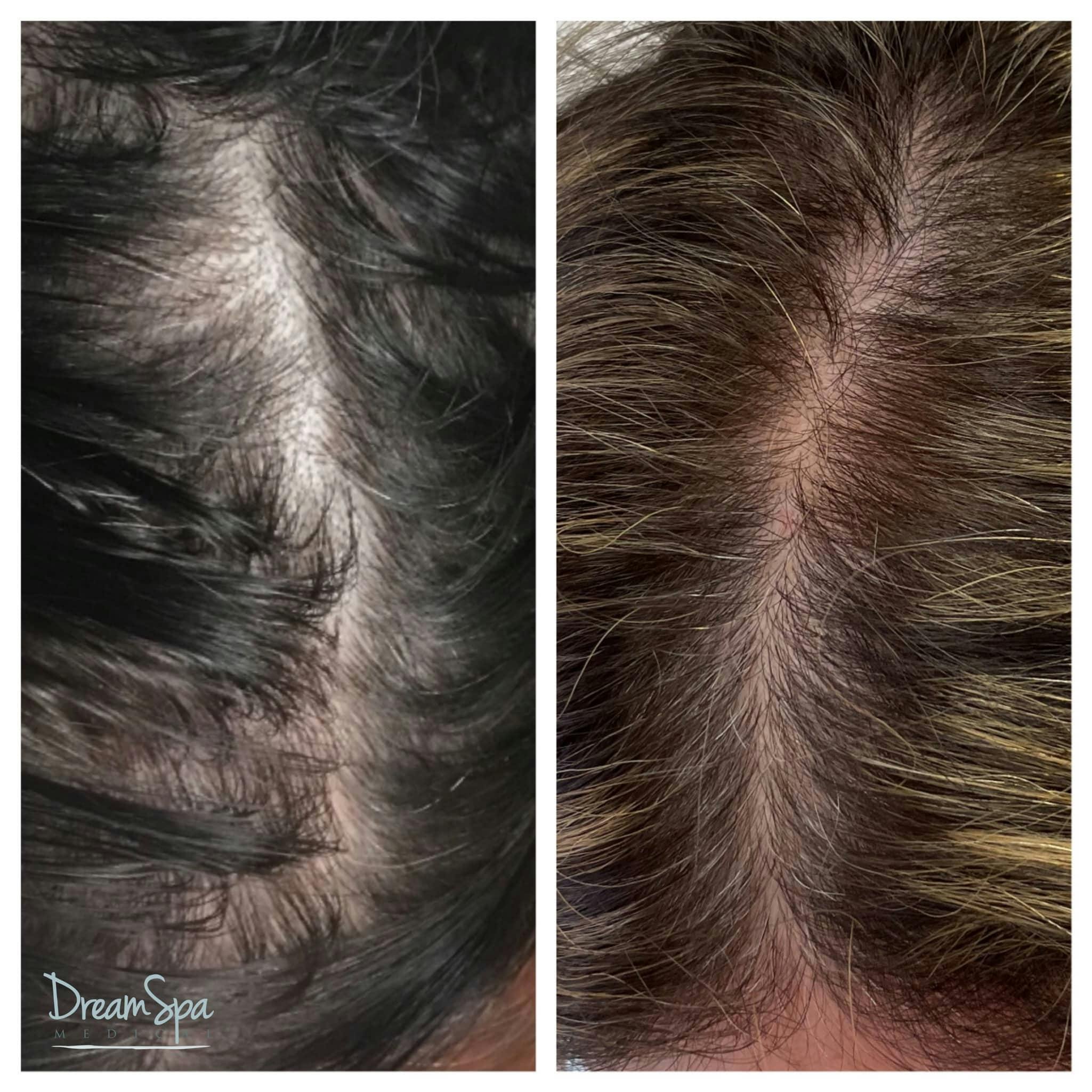 Hair Restoration Before & After Gallery - Patient 123429619 - Image 1