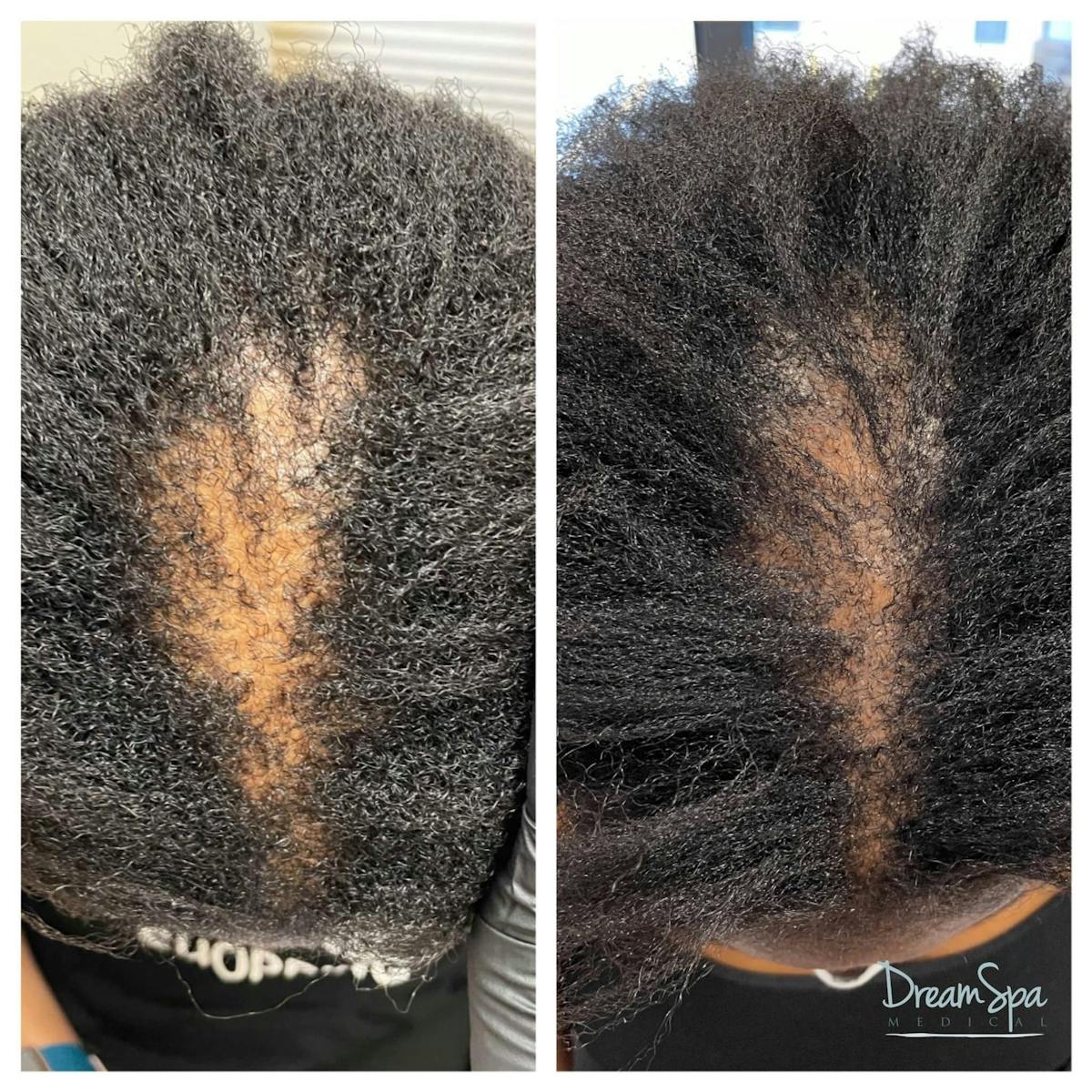 Hair Restoration Before & After Gallery - Patient 123429620 - Image 1