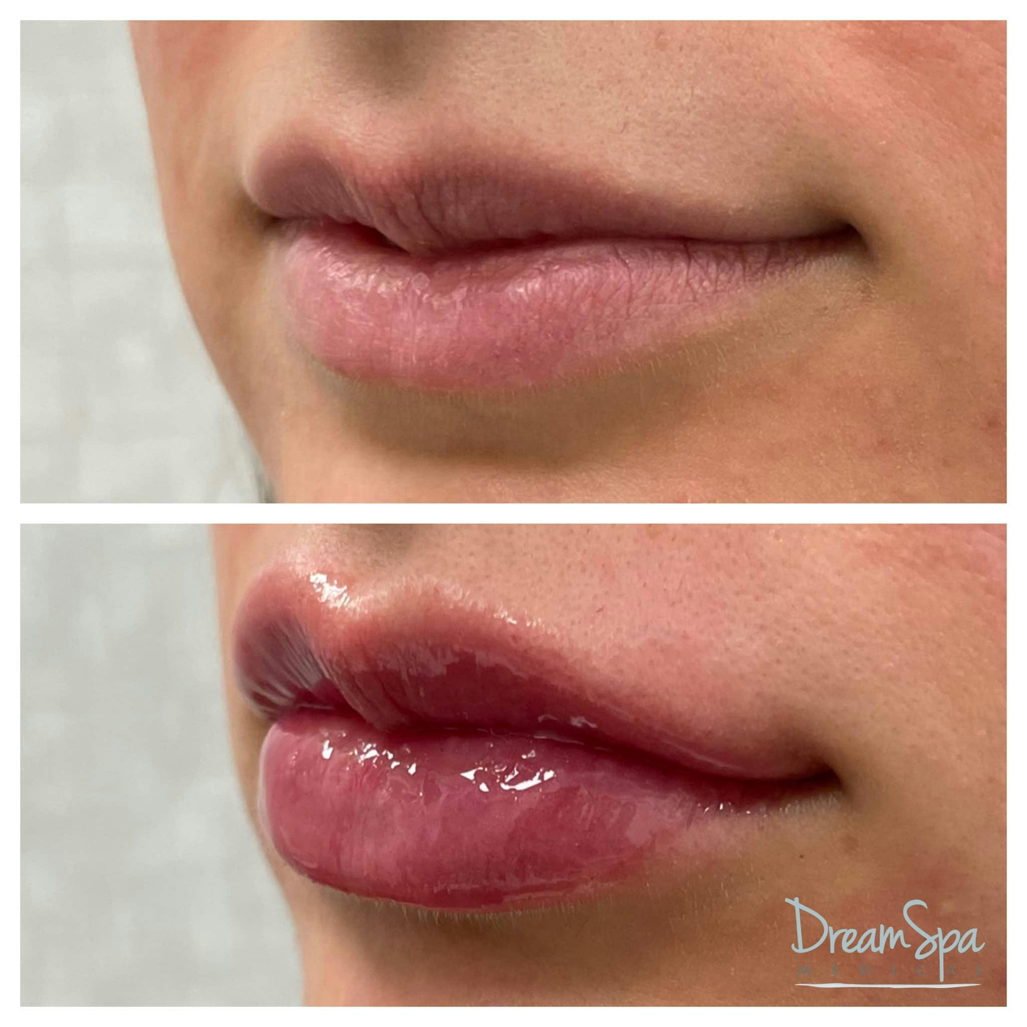 Lip Filler Before & After Gallery - Patient 123429697 - Image 1