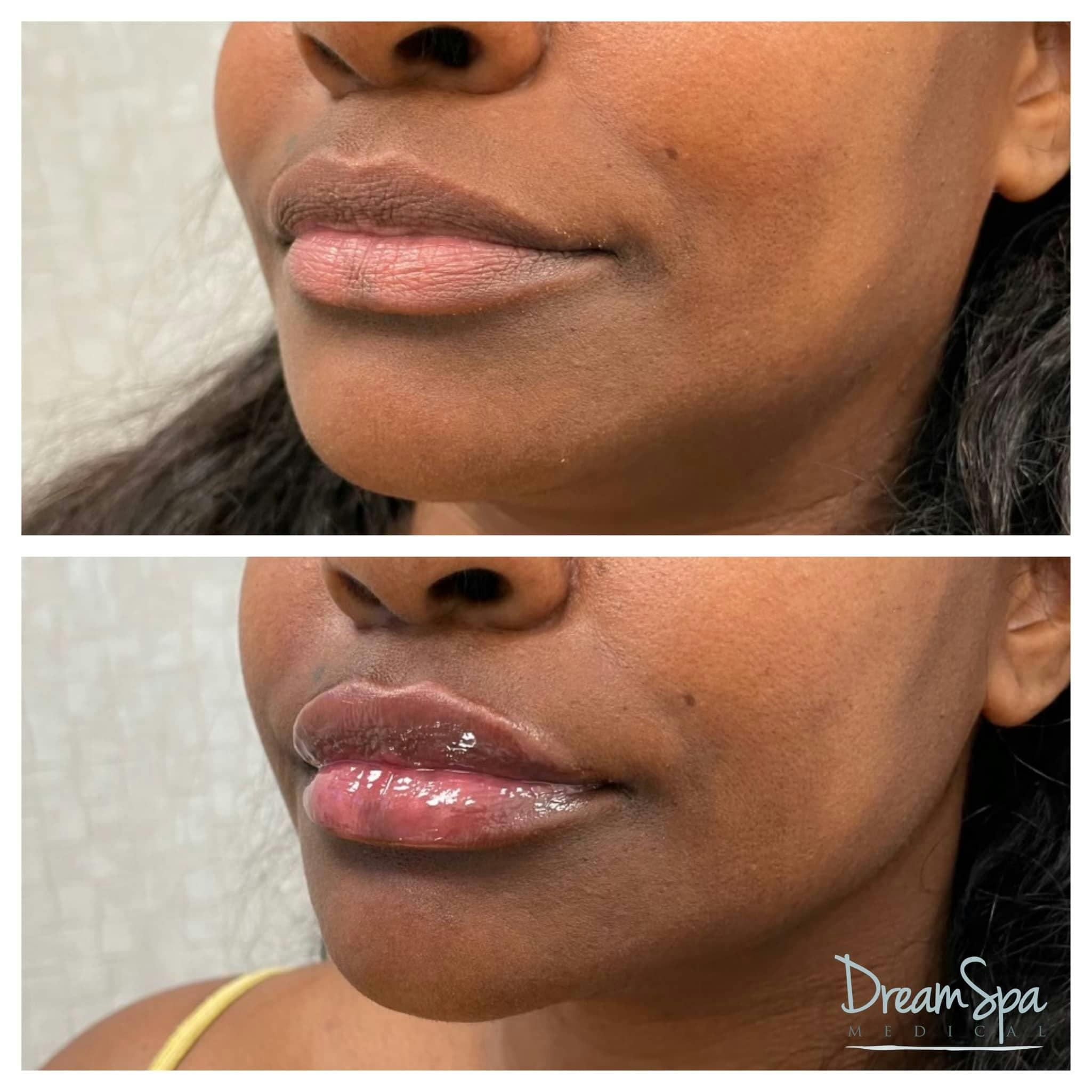 Lip Filler Before & After Gallery - Patient 123429698 - Image 1