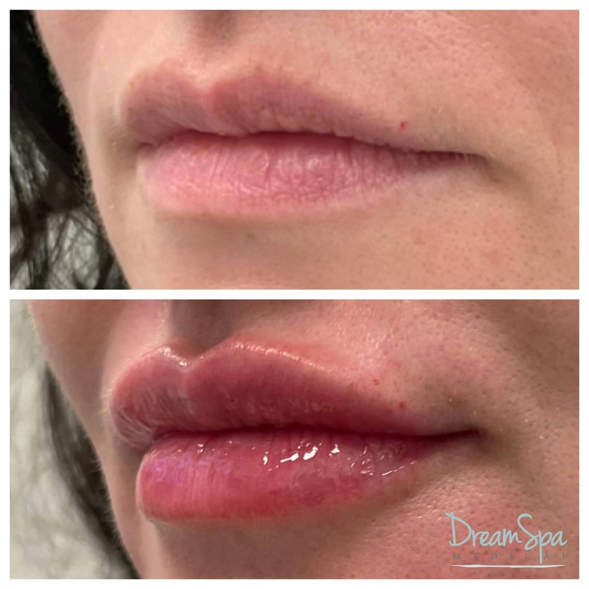 Lip Filler Before & After Gallery - Patient 123429699 - Image 1