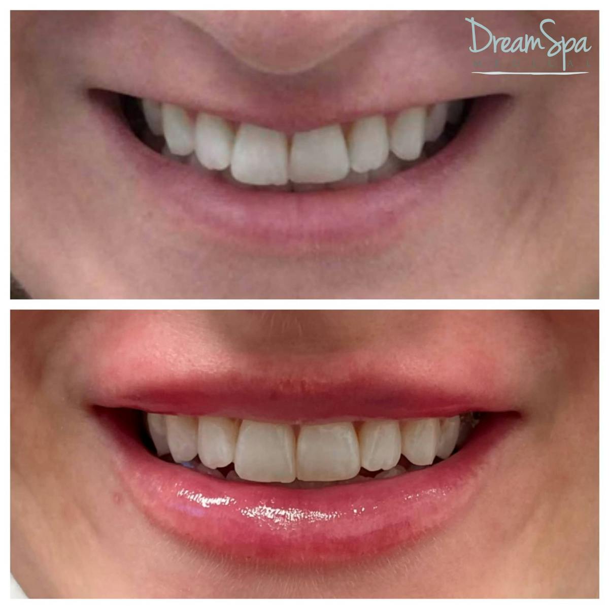 Lip Filler Before & After Gallery - Patient 123429700 - Image 1