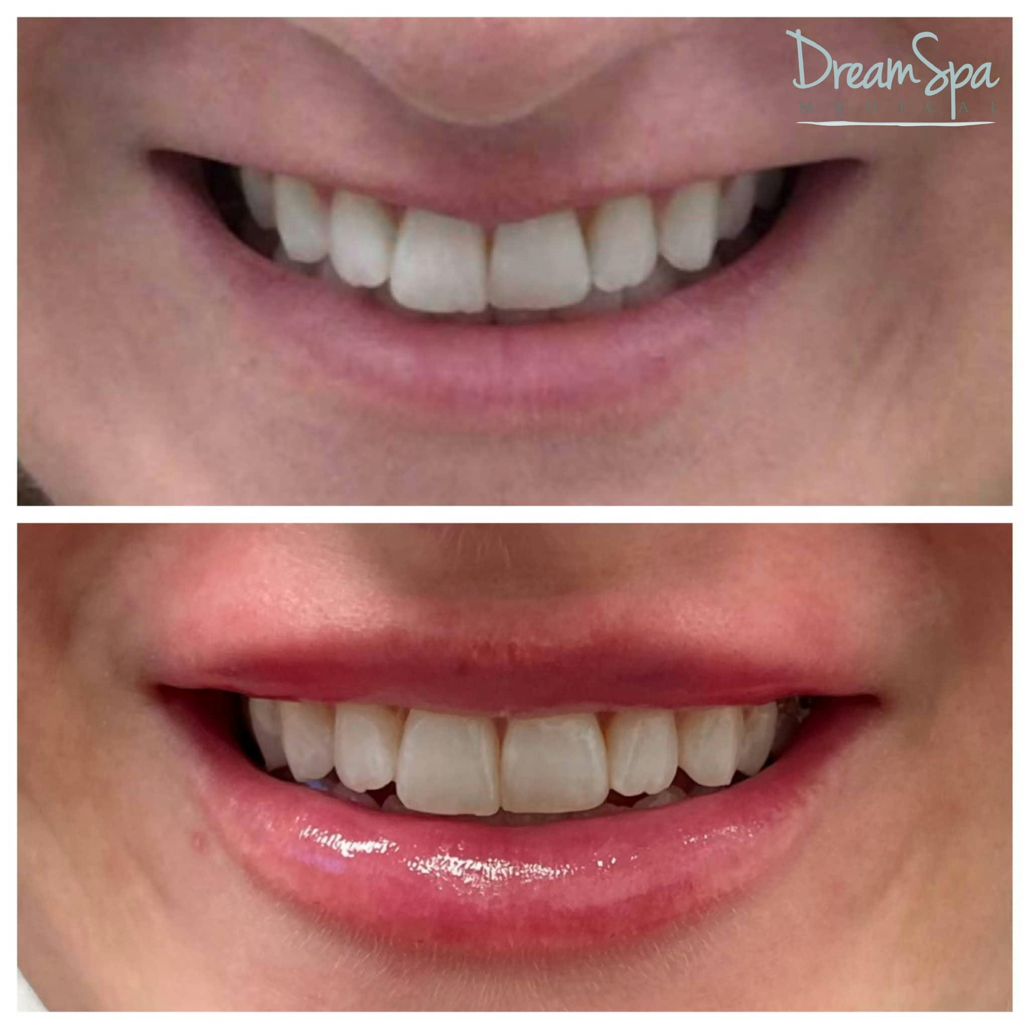 Lip Filler Before & After Gallery - Patient 123429700 - Image 1
