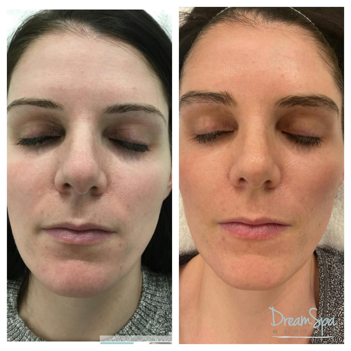 Skin Care Before & After Gallery - Patient 145103528 - Image 1