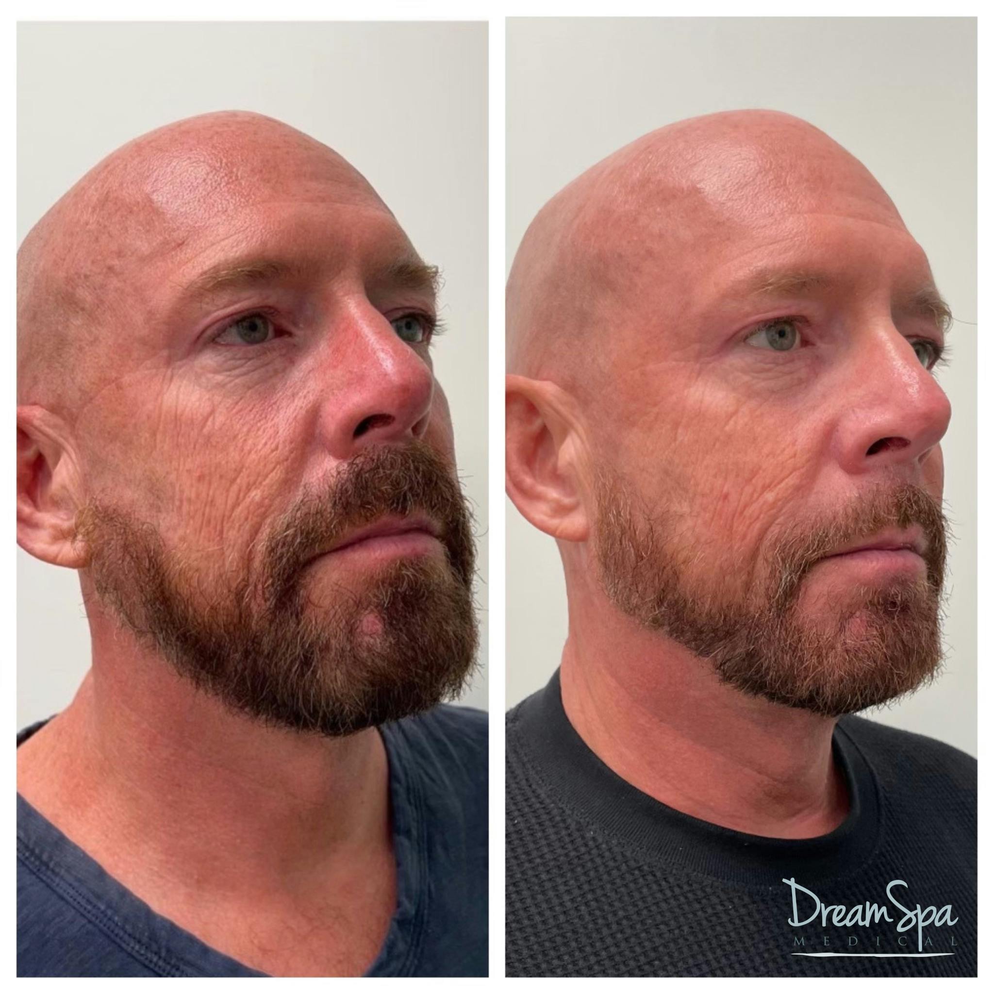 Sculptra Before & After Gallery - Patient 145103571 - Image 1