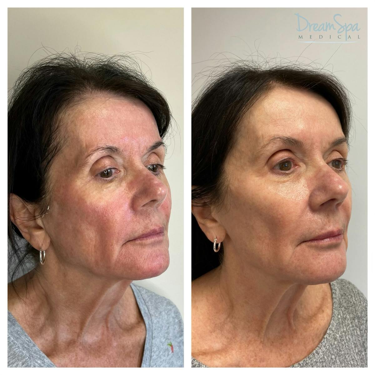 Sculptra Before & After Gallery - Patient 145103570 - Image 1