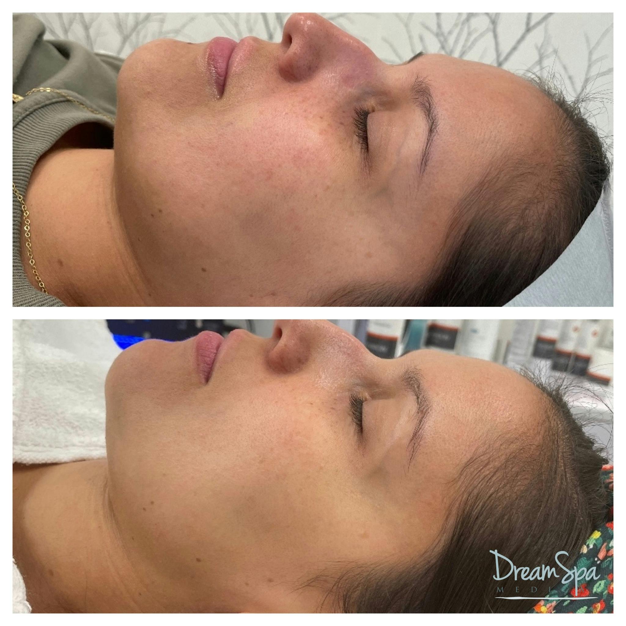 Sylfirm X Before & After Gallery - Patient 145103580 - Image 1