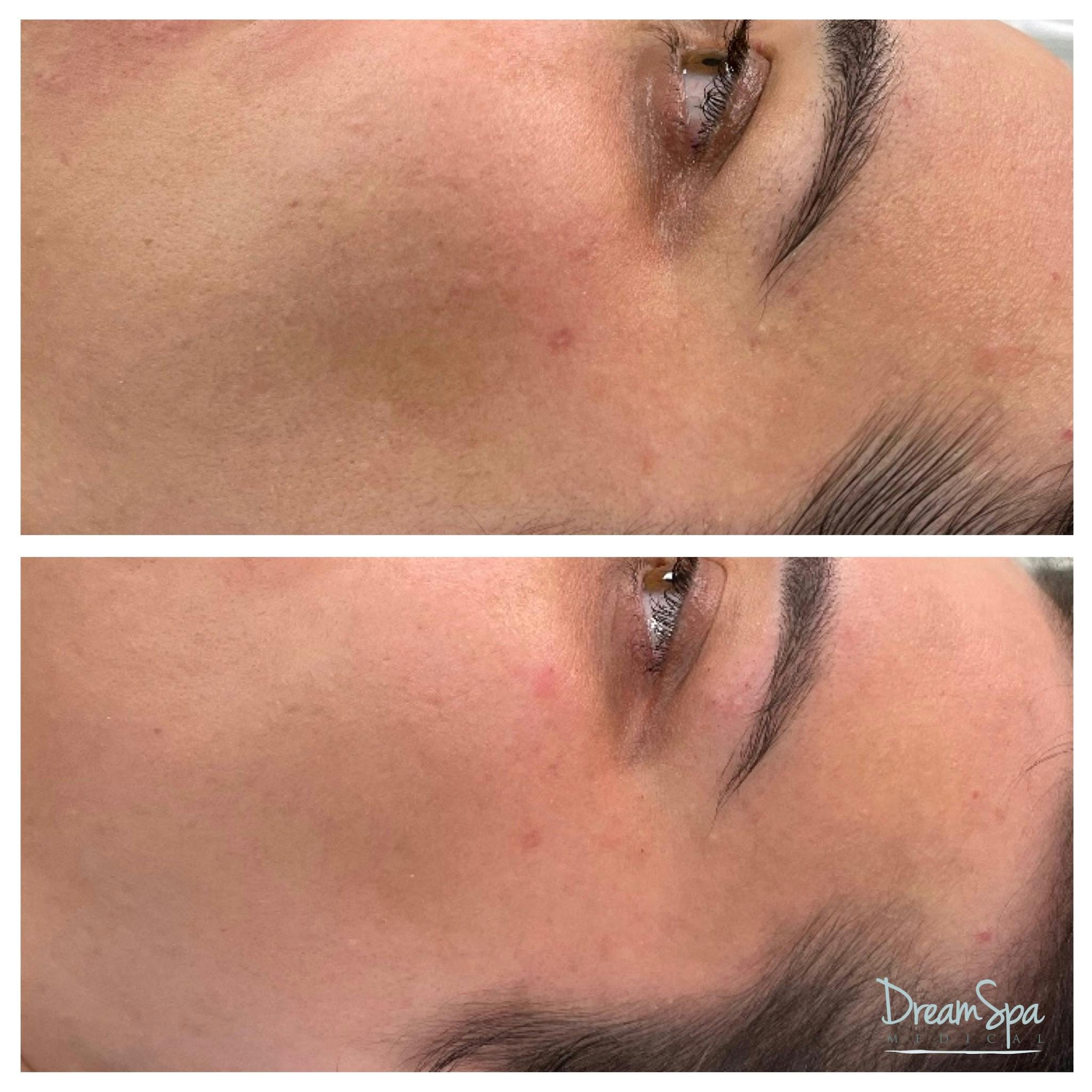 Sylfirm X Before & After Gallery - Patient 145103579 - Image 1