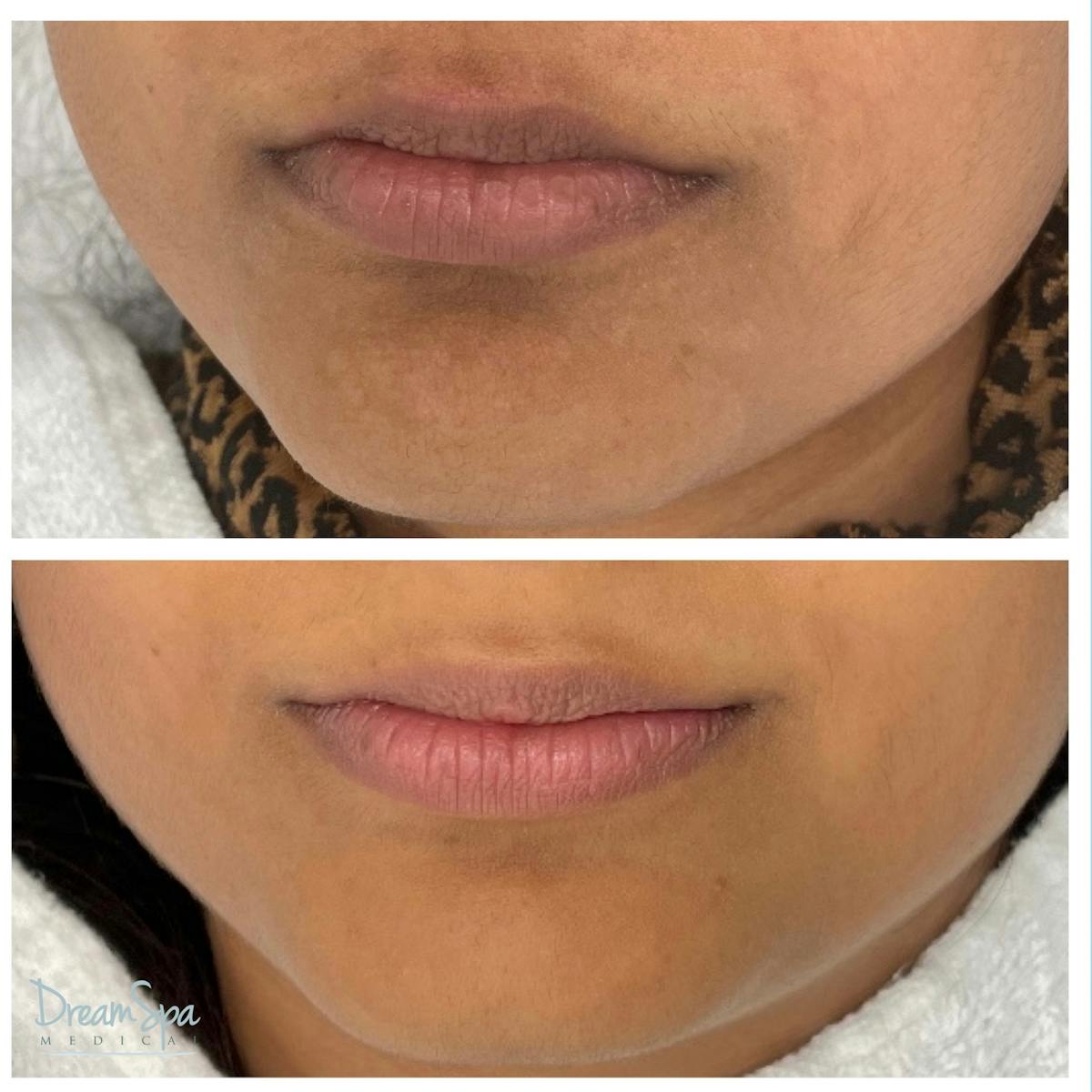 Sylfirm X Before & After Gallery - Patient 145103578 - Image 1