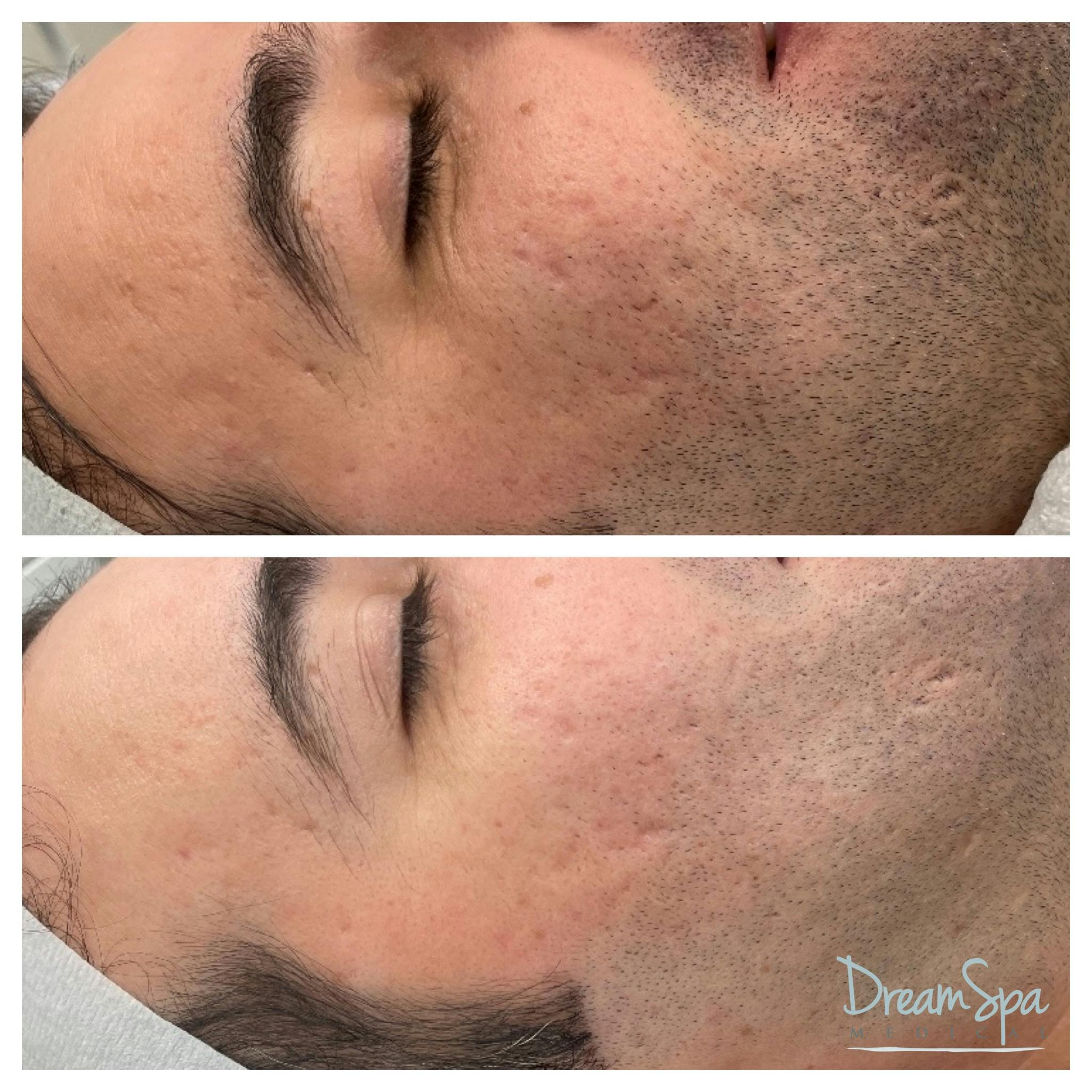 Acne Clinic Before & After Gallery - Patient 145103674 - Image 1