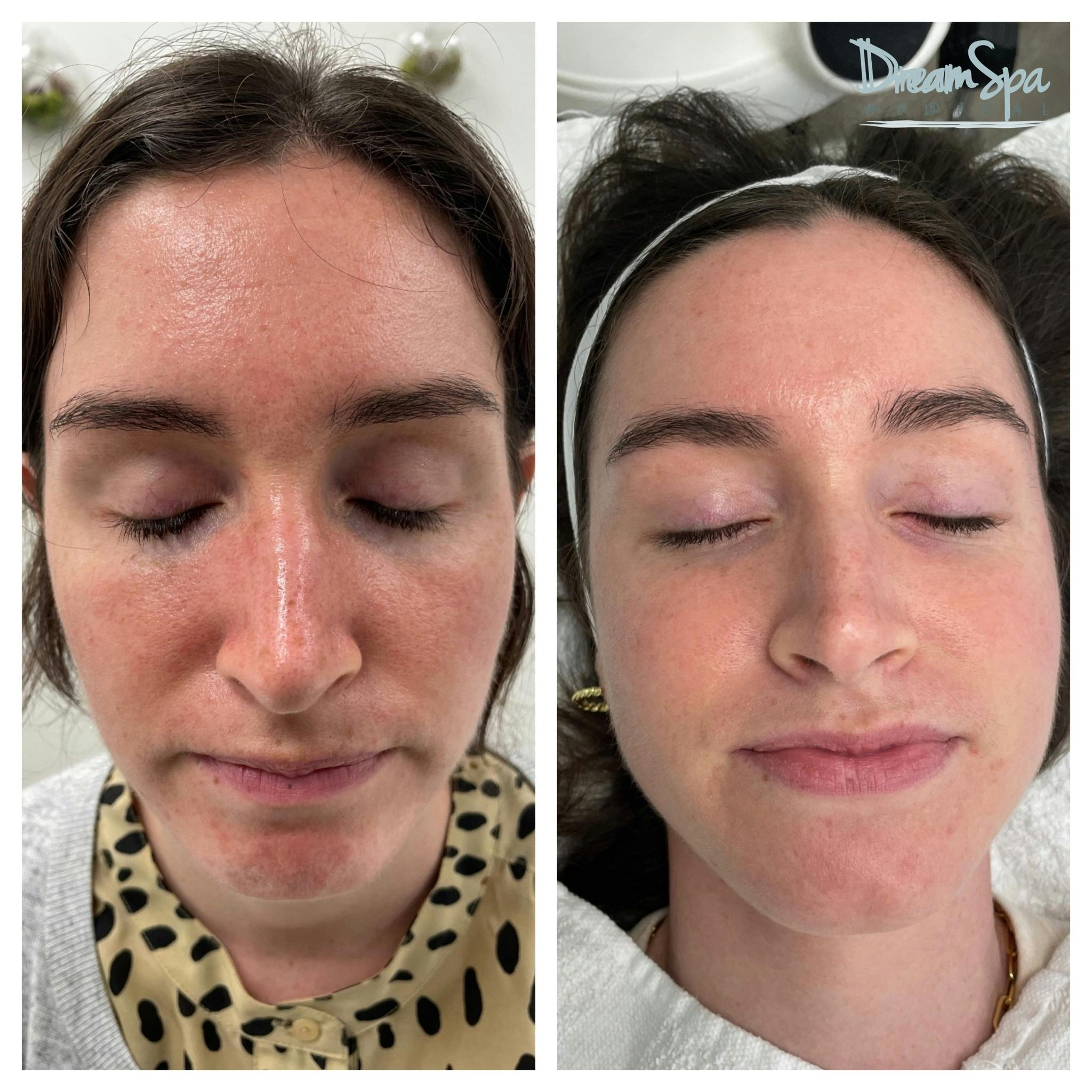 Acne Clinic Before & After Gallery - Patient 145103673 - Image 1