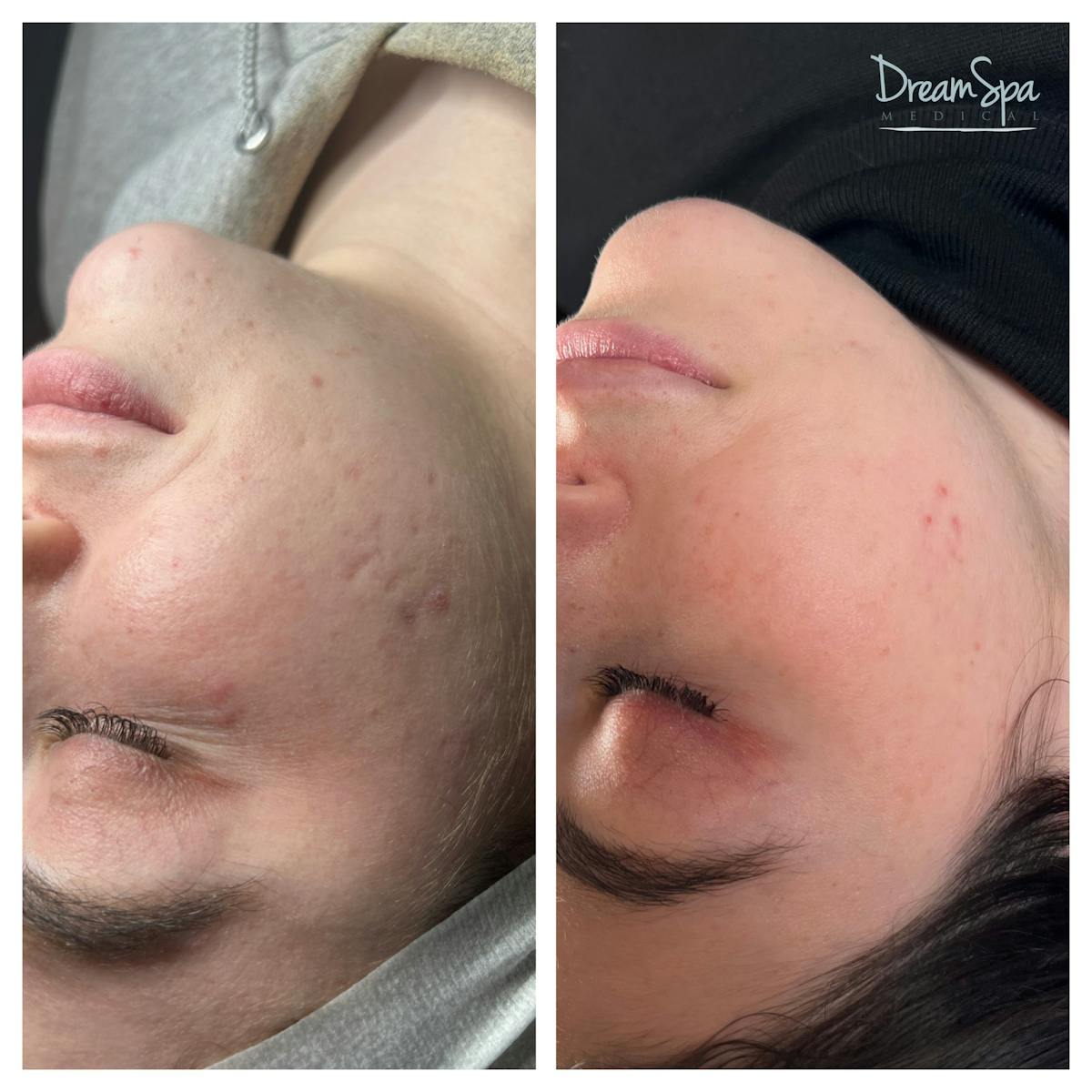Acne Clinic Before & After Gallery - Patient 145103672 - Image 1