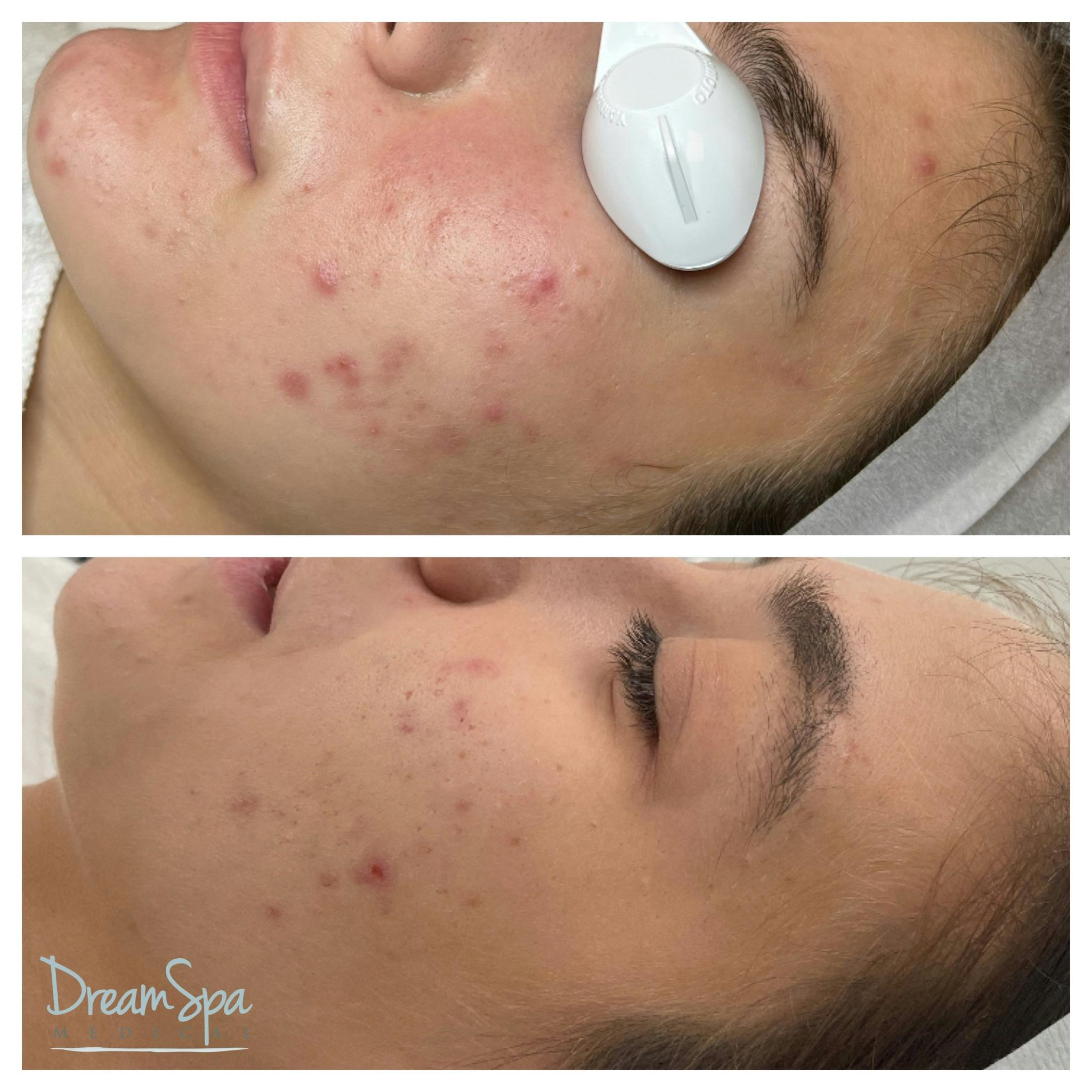 Acne Clinic Before & After Gallery - Patient 145103671 - Image 1