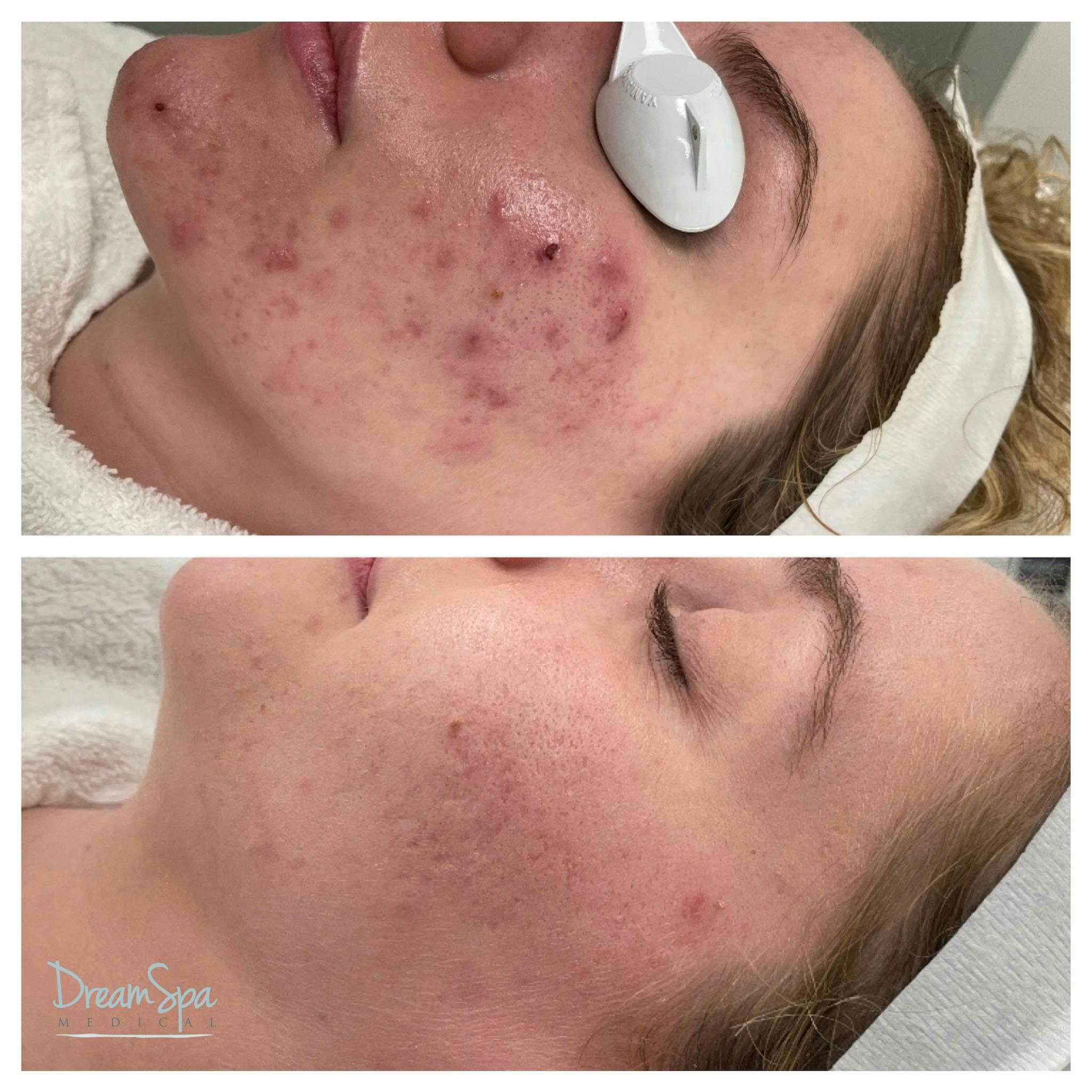 Acne Clinic Before & After Gallery - Patient 145103670 - Image 1