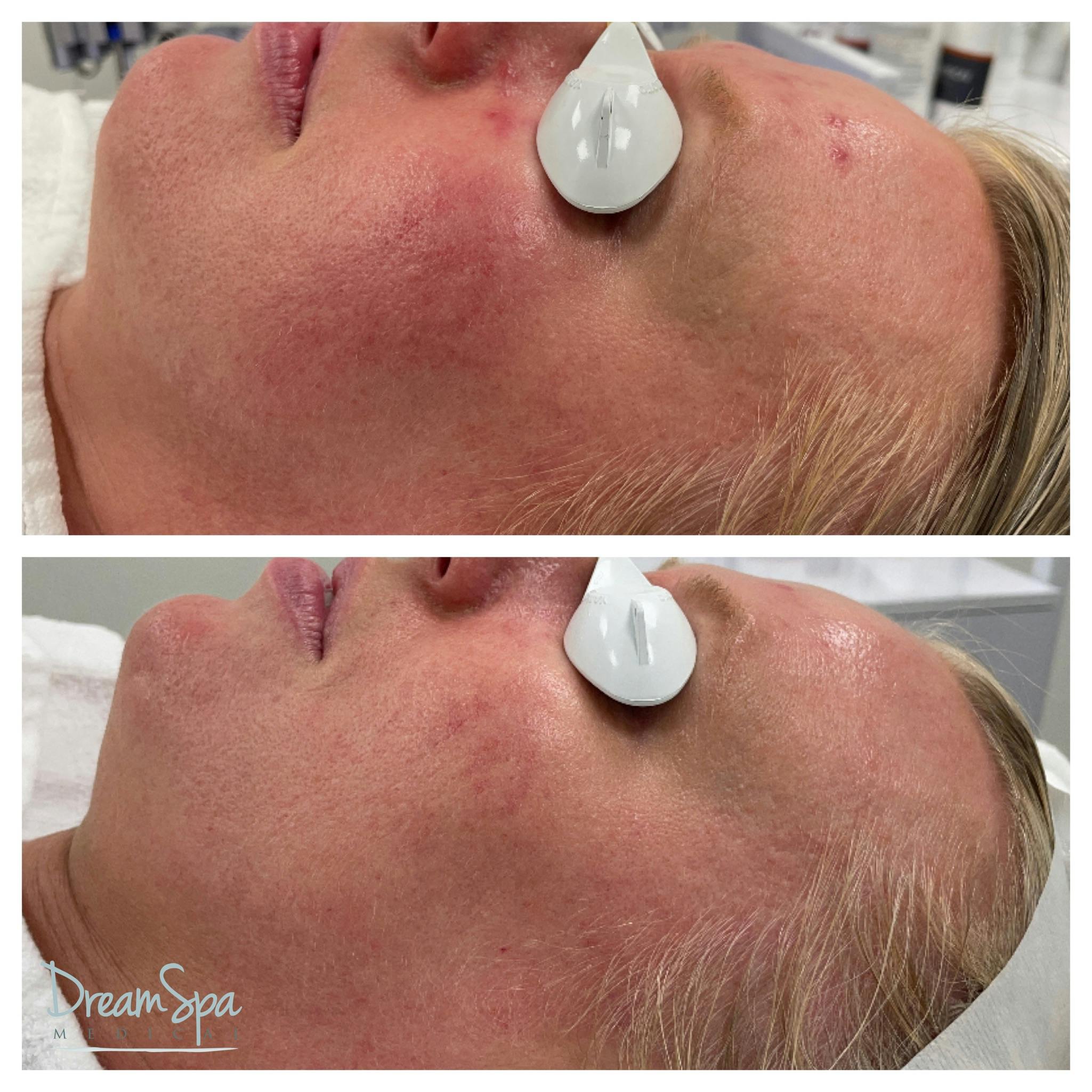 Acne Clinic Before & After Gallery - Patient 145103669 - Image 1