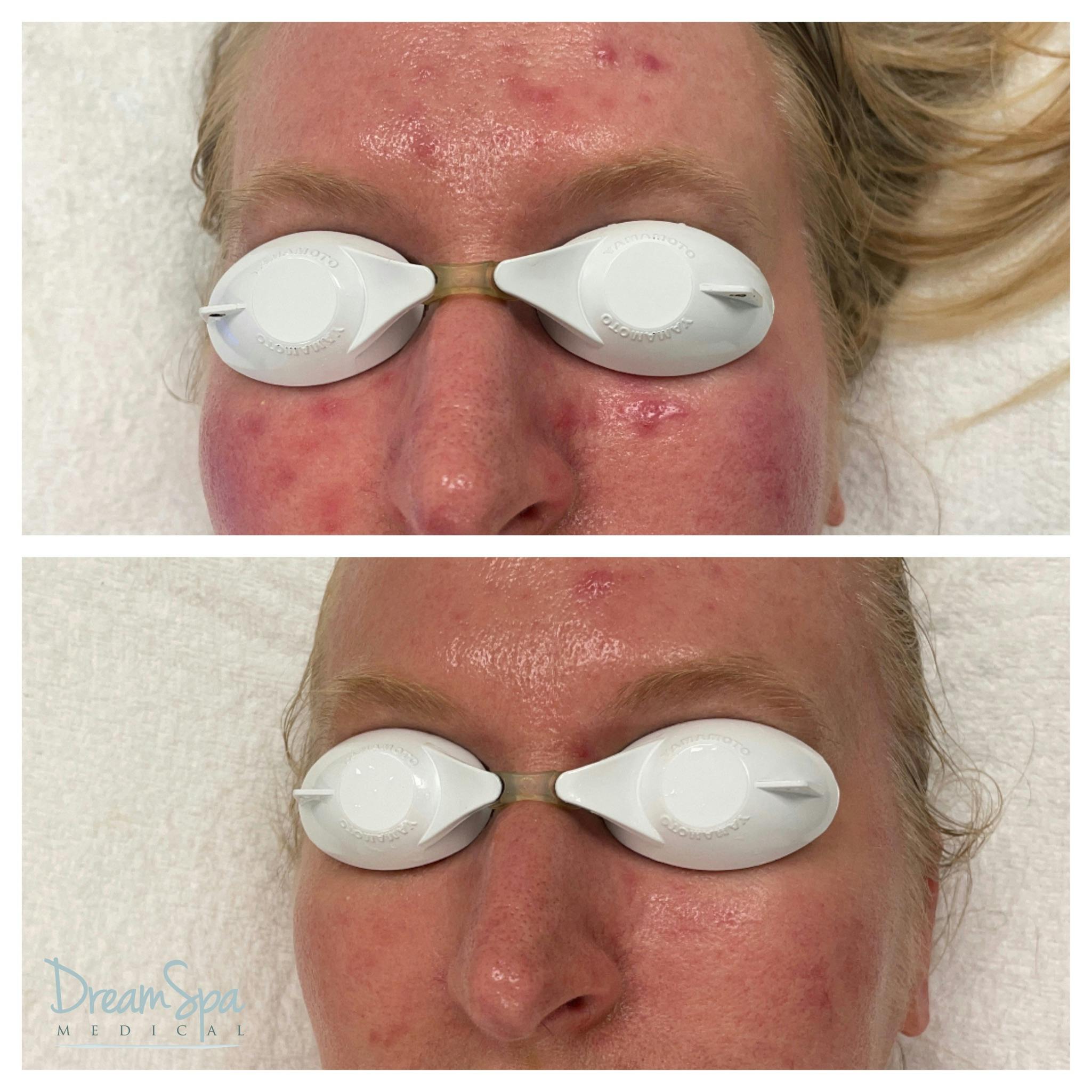 Acne Clinic Before & After Gallery - Patient 145103668 - Image 1
