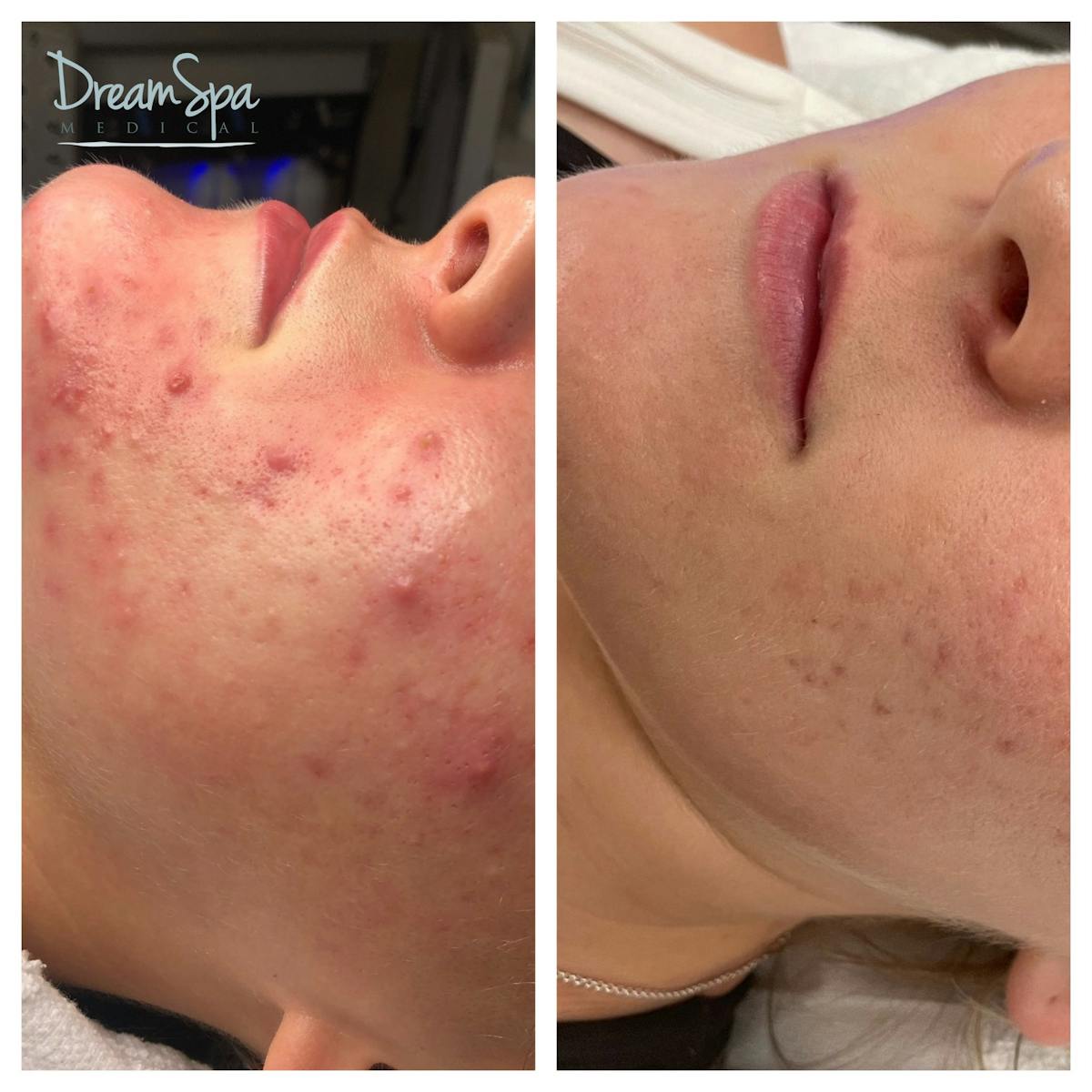 Acne Clinic Before & After Gallery - Patient 145103667 - Image 1