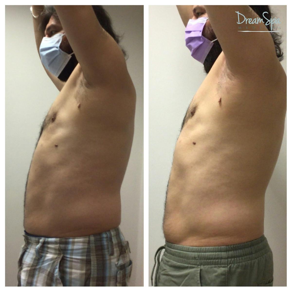 Body Contouring Before & After Gallery - Patient 145103723 - Image 1
