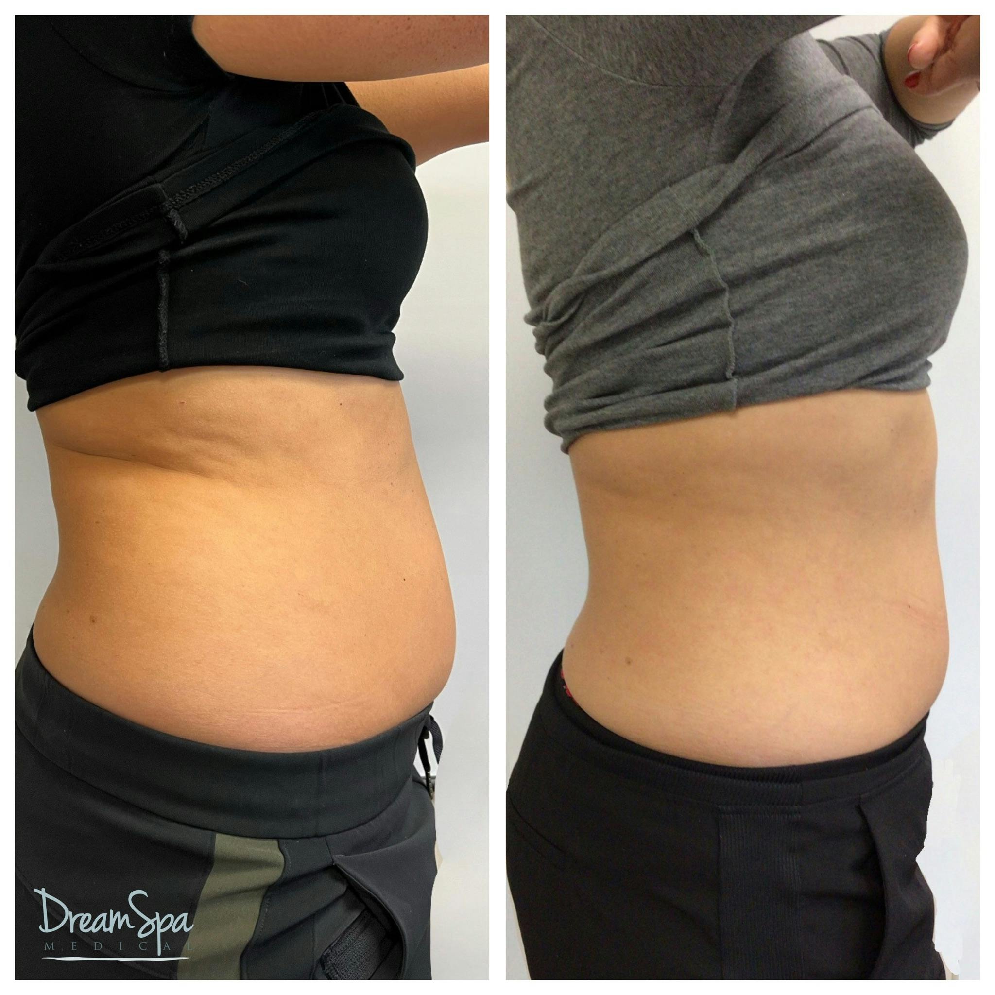 Body Contouring Before & After Gallery - Patient 145103722 - Image 1