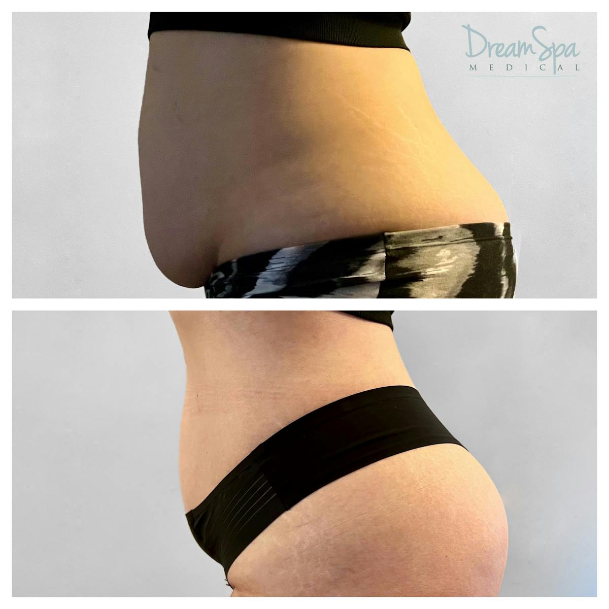 Body Contouring Before & After Gallery - Patient 145103721 - Image 1