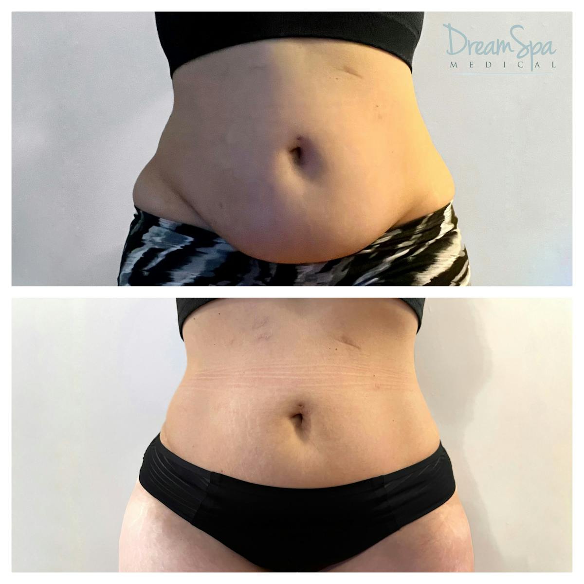 Body Contouring Before & After Gallery - Patient 145103720 - Image 1