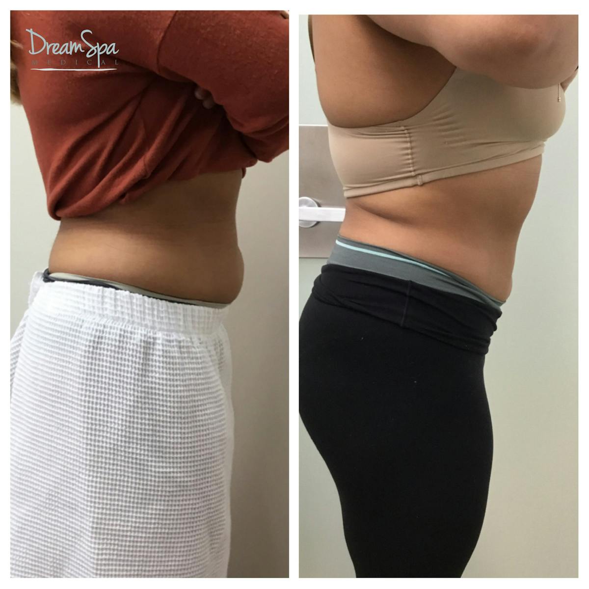 Body Contouring Before & After Gallery - Patient 145103719 - Image 1