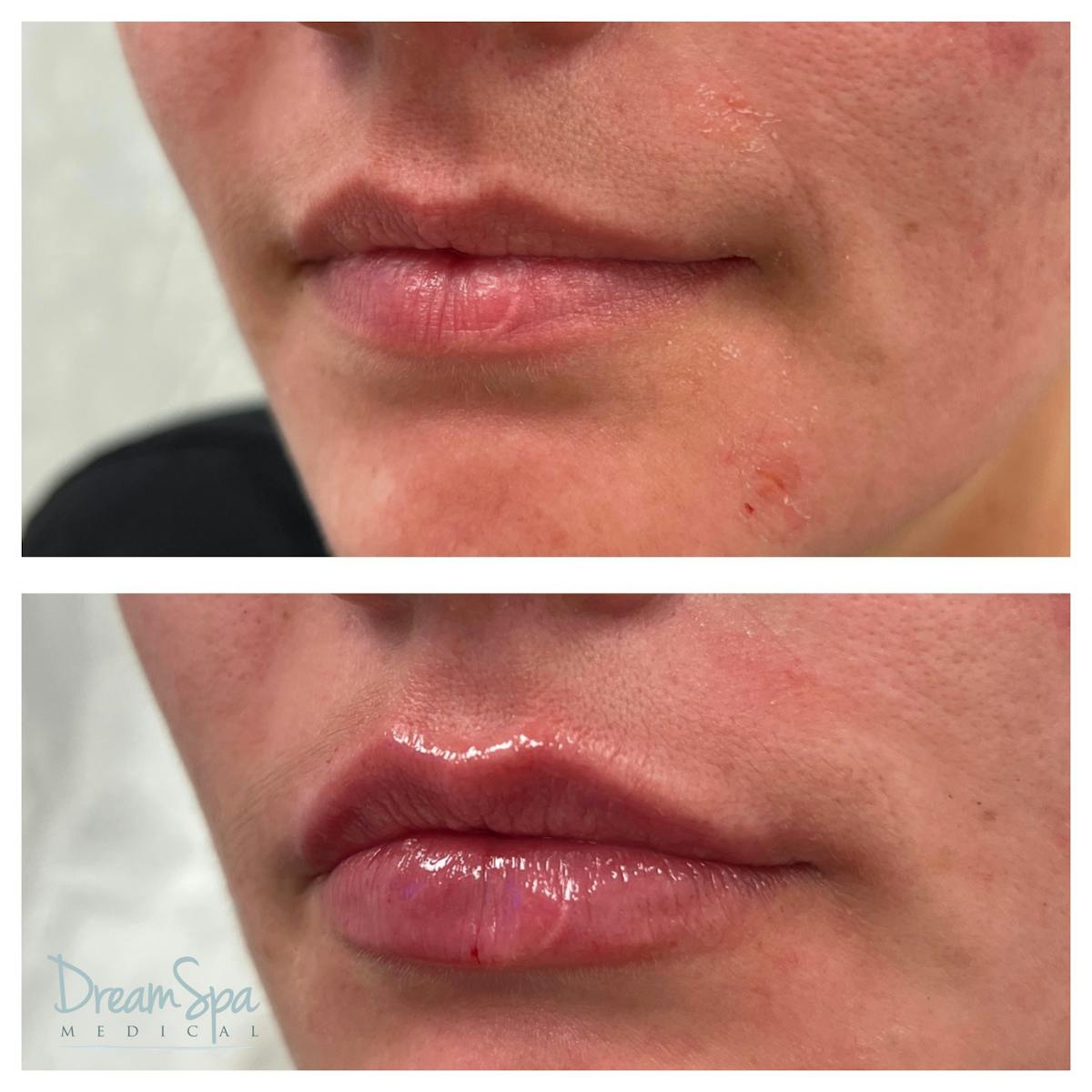 Lip Filler Before & After Gallery - Patient 145103746 - Image 1