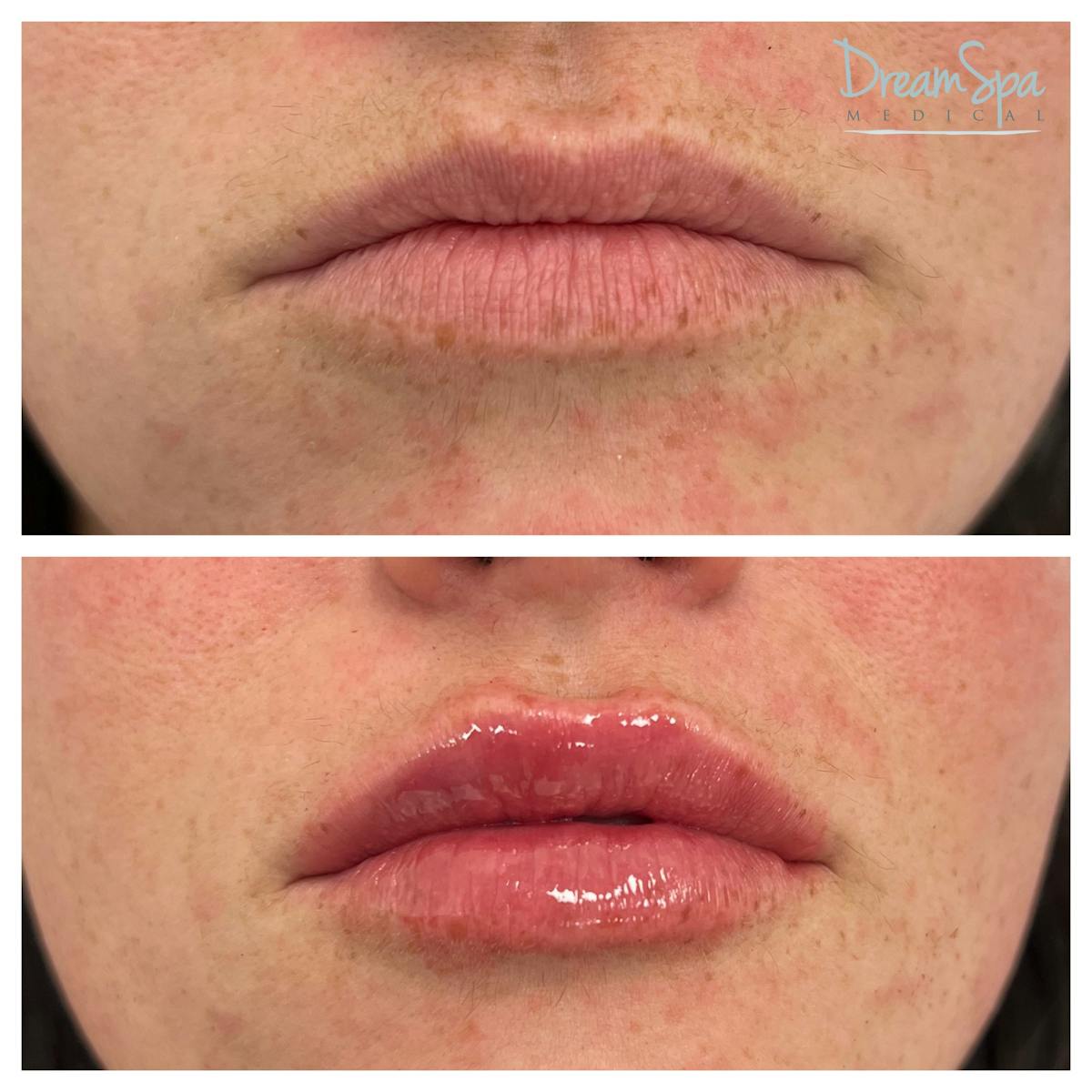 Lip Filler Before & After Gallery - Patient 145103745 - Image 1