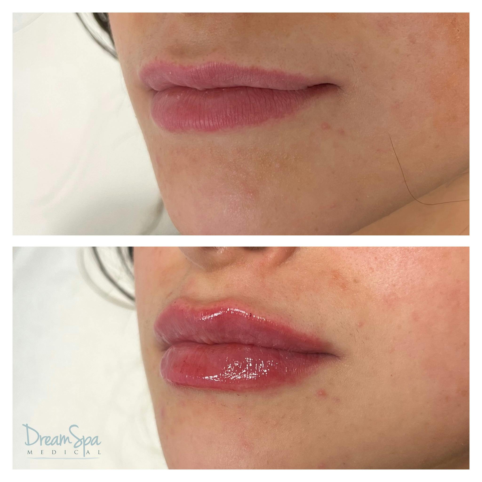 Lip Filler Before & After Gallery - Patient 145103744 - Image 1