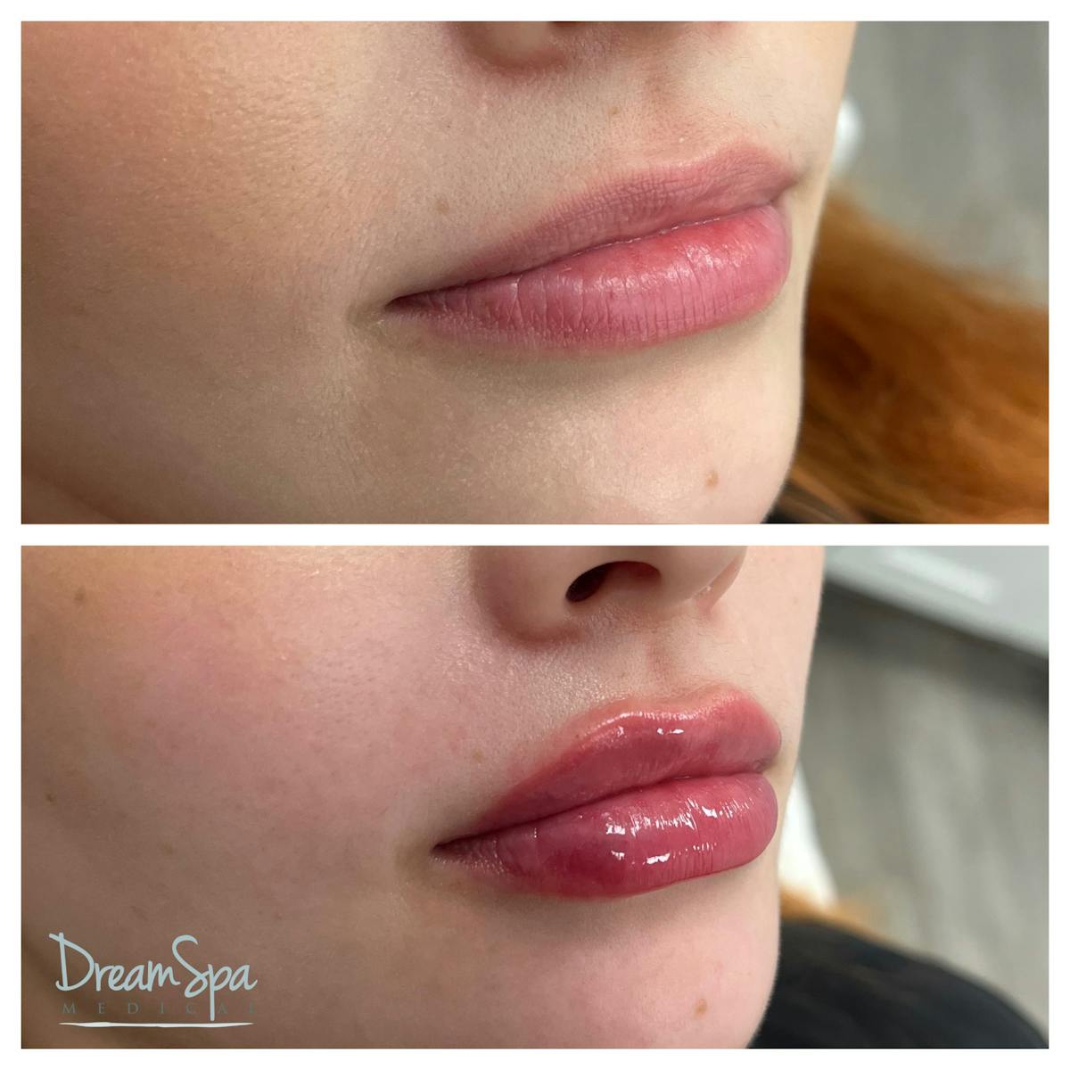 Lip Filler Before & After Gallery - Patient 145103743 - Image 1