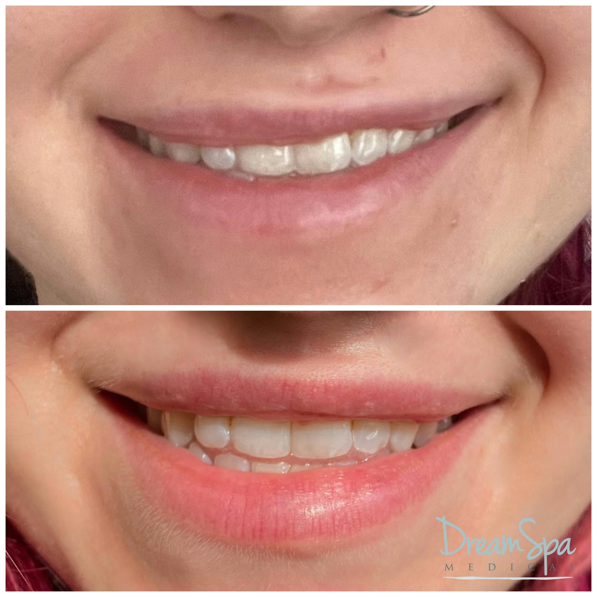 Lip Filler Before & After Gallery - Patient 145103742 - Image 1