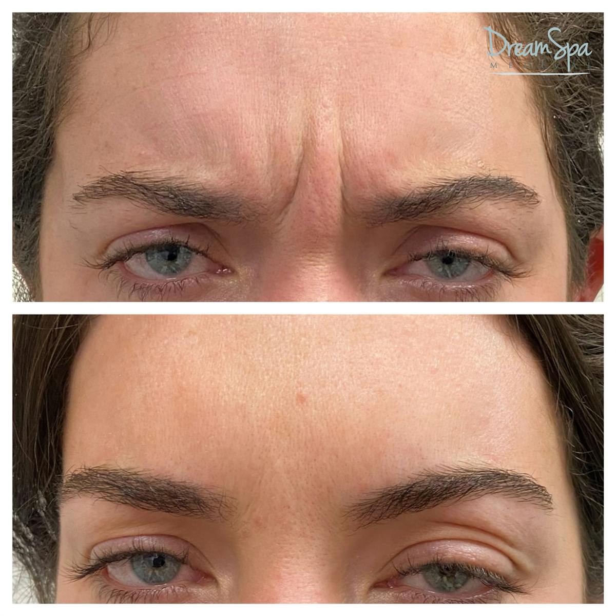 Botox Before & After Gallery - Patient 145103764 - Image 1