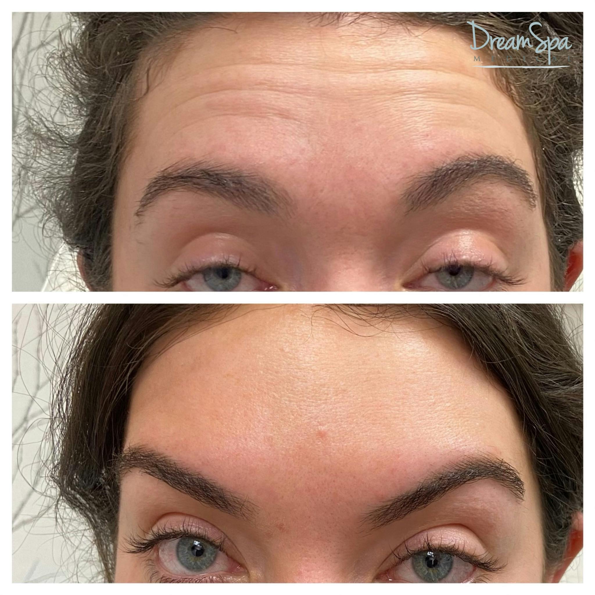 Botox Before & After Gallery - Patient 145103764 - Image 2