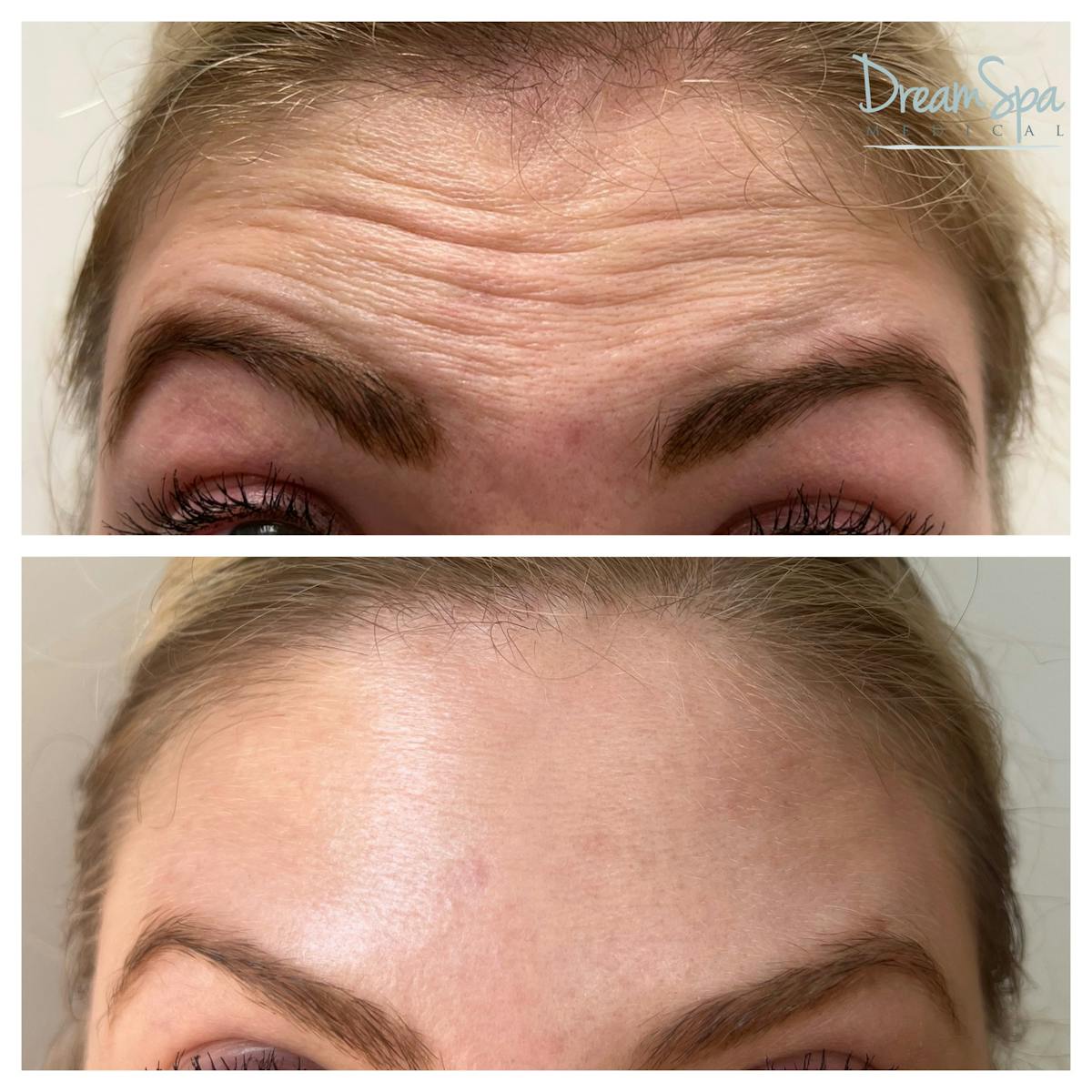 Botox Before & After Gallery - Patient 145103763 - Image 1