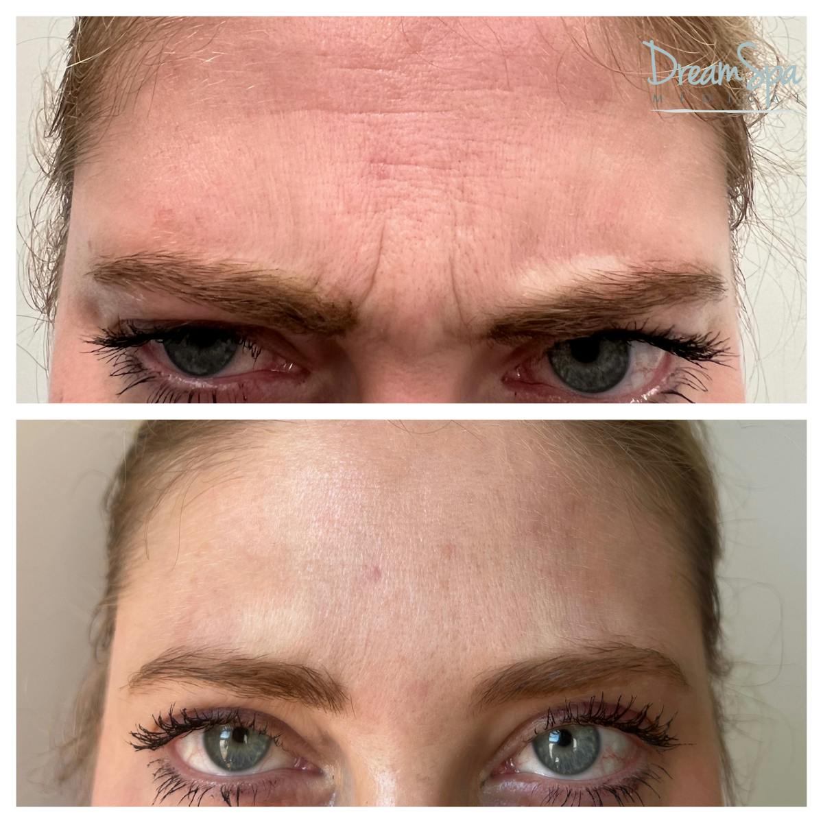 Botox Before & After Gallery - Patient 145103763 - Image 2