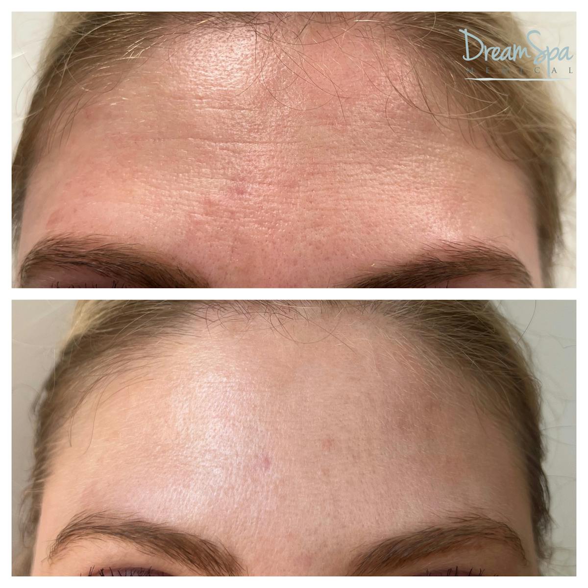 Botox Before & After Gallery - Patient 145103763 - Image 3