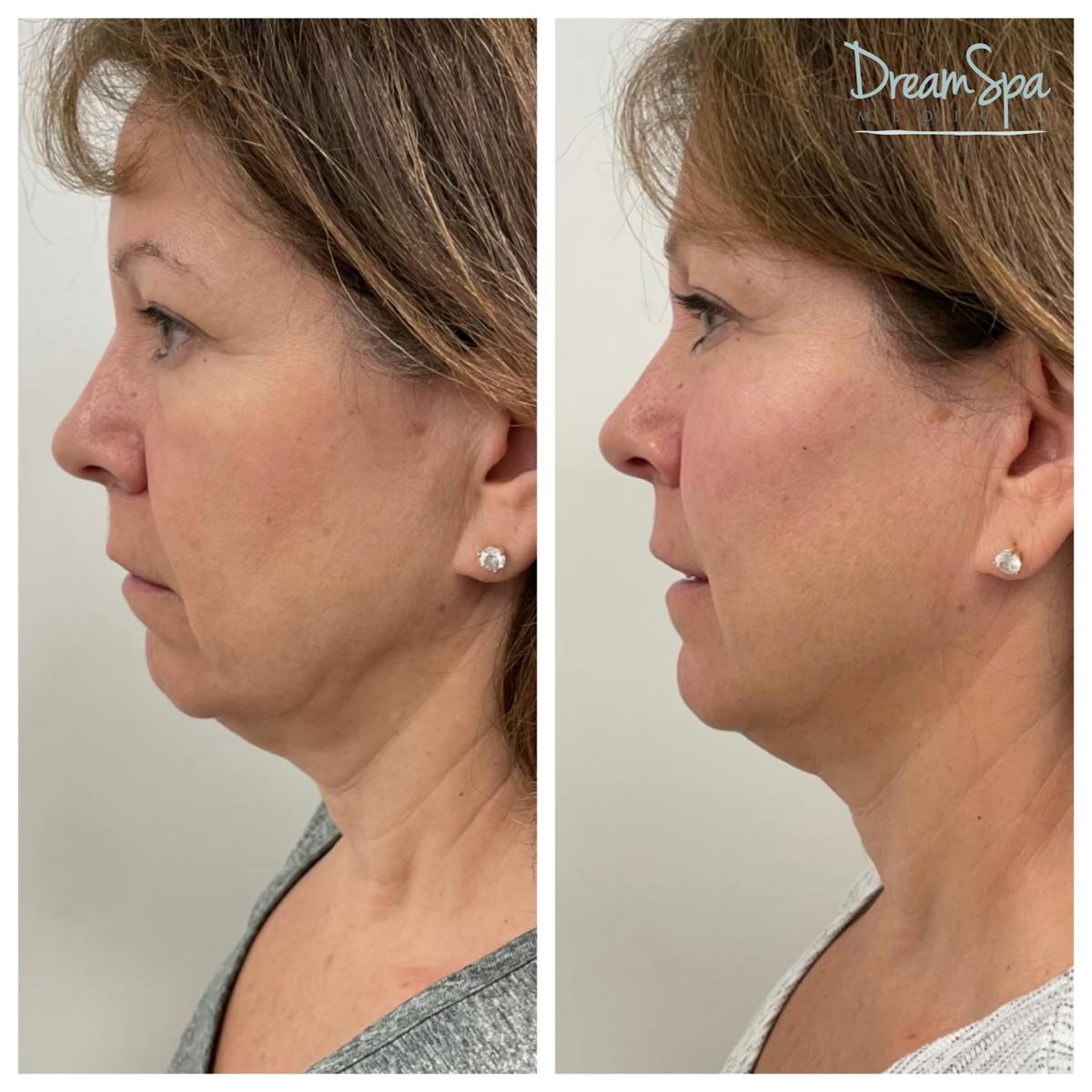 Dream Lift Before & After Gallery - Patient 145103769 - Image 1
