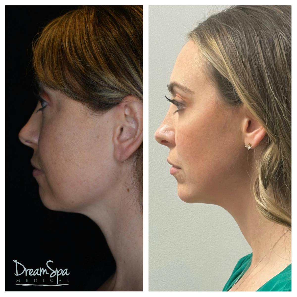 Dream Restore Before & After Gallery - Patient 145103773 - Image 1