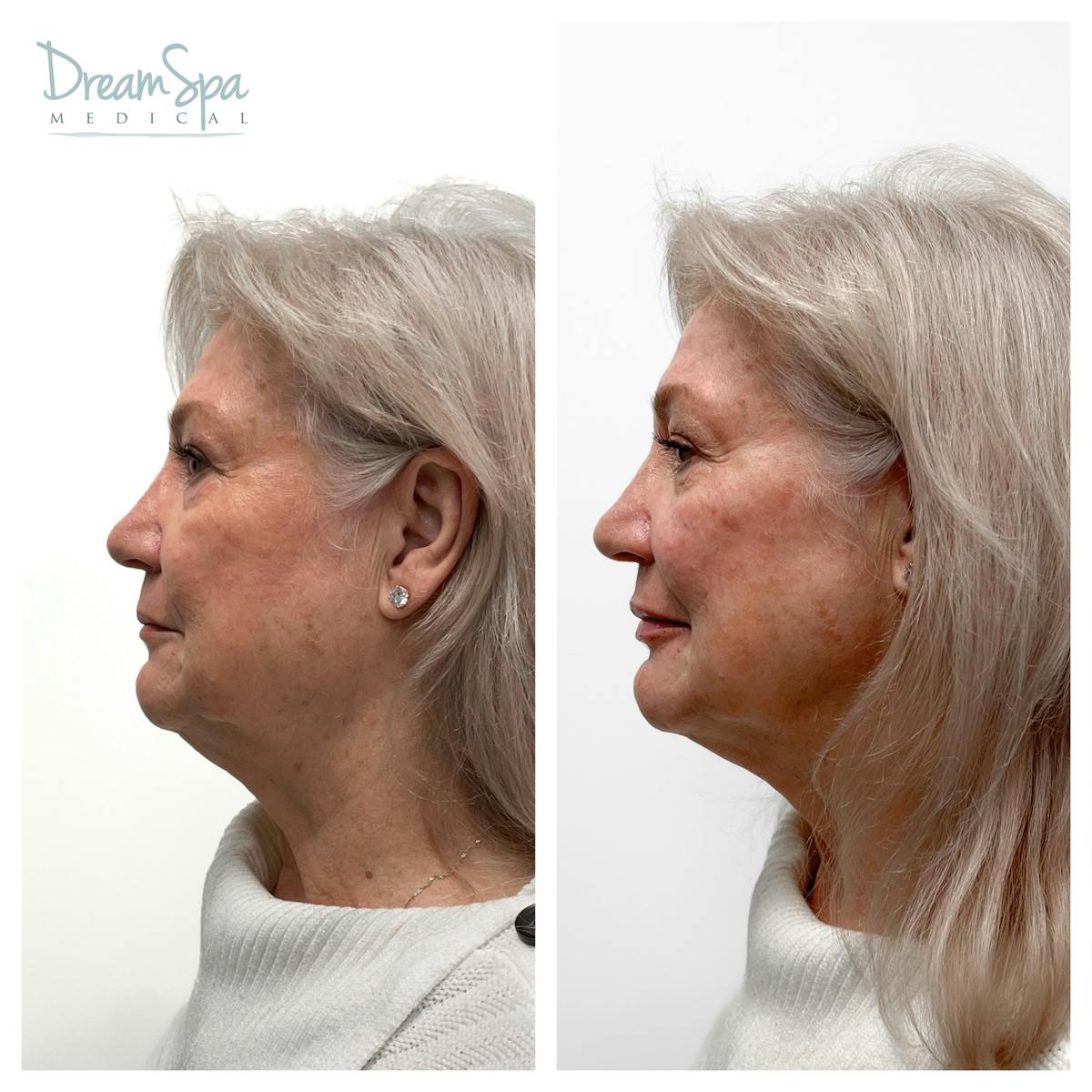 Dream Restore Before & After Gallery - Patient 145103772 - Image 1