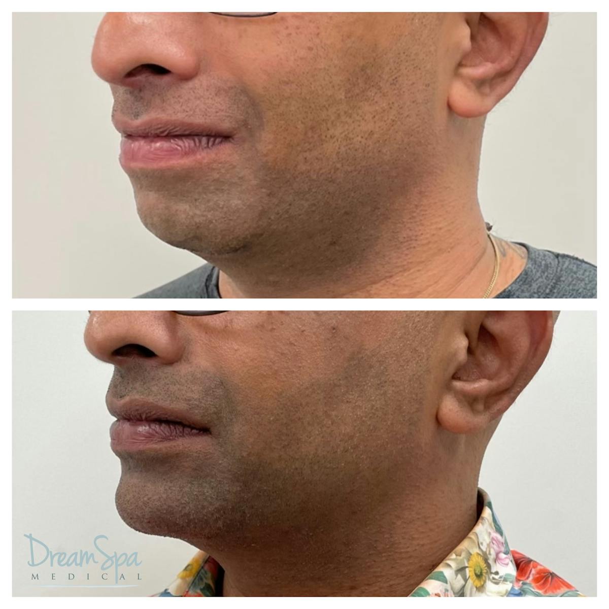 Masculine Jawline Filler Before & After Gallery - Patient 145103831 - Image 1