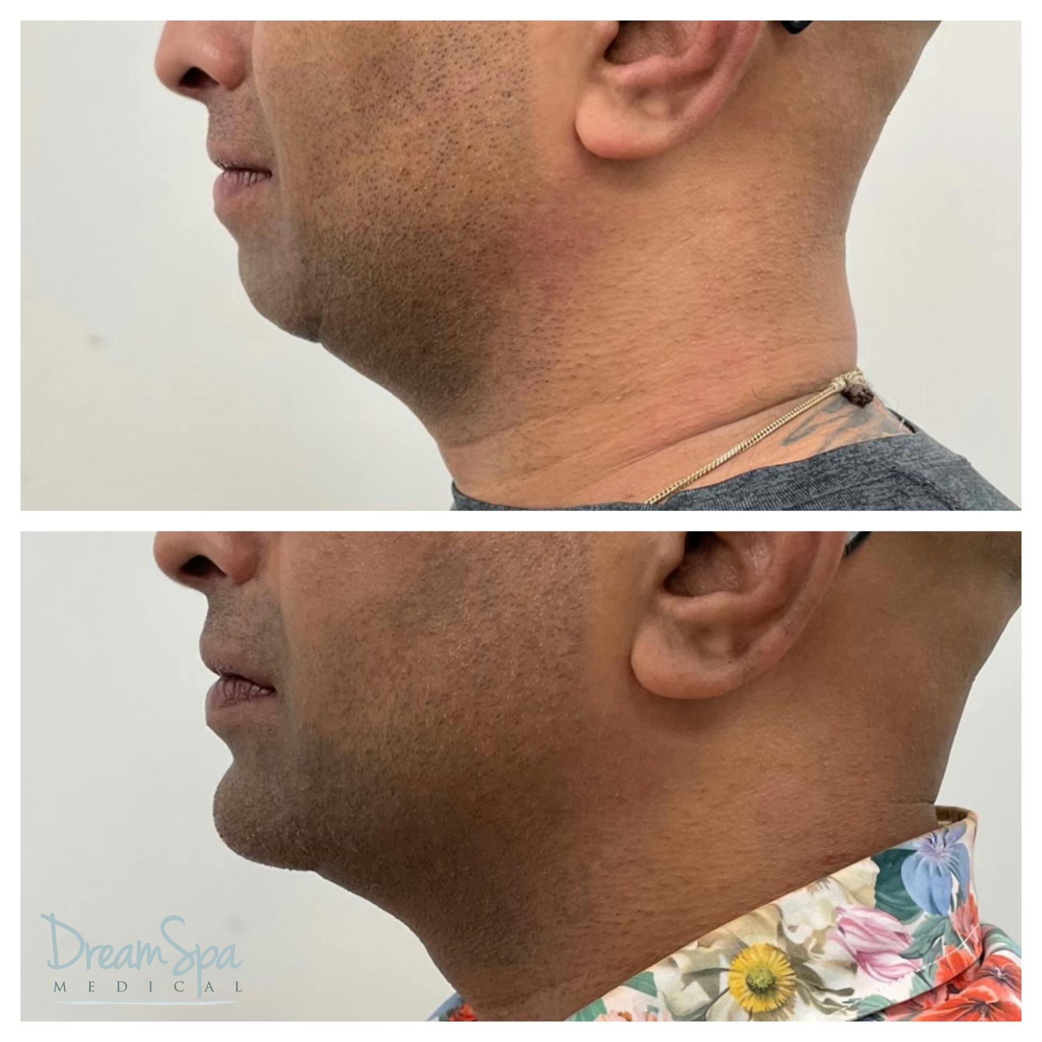 Masculine Jawline Filler Before & After Gallery - Patient 145103831 - Image 2
