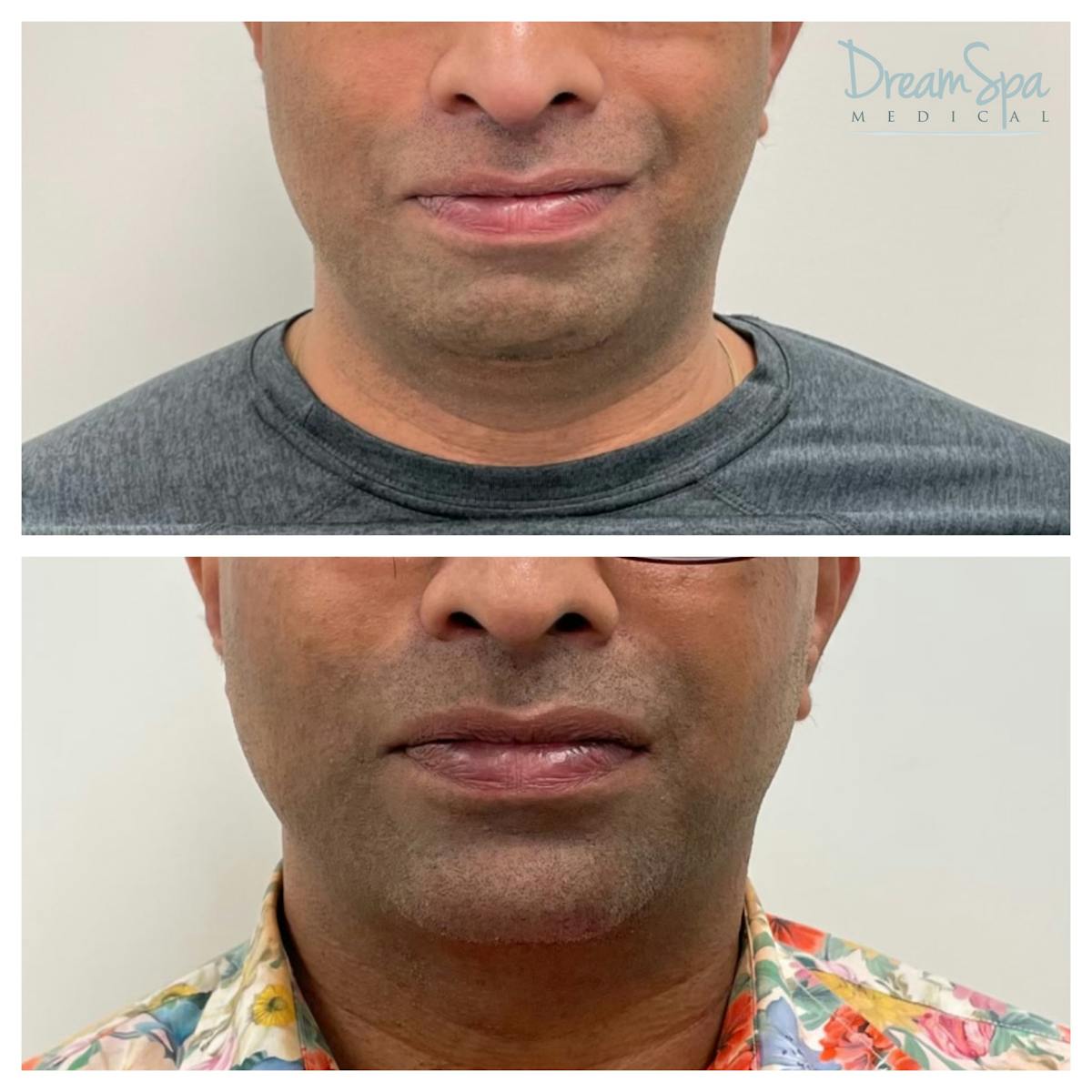 Masculine Jawline Filler Before & After Gallery - Patient 145103831 - Image 3