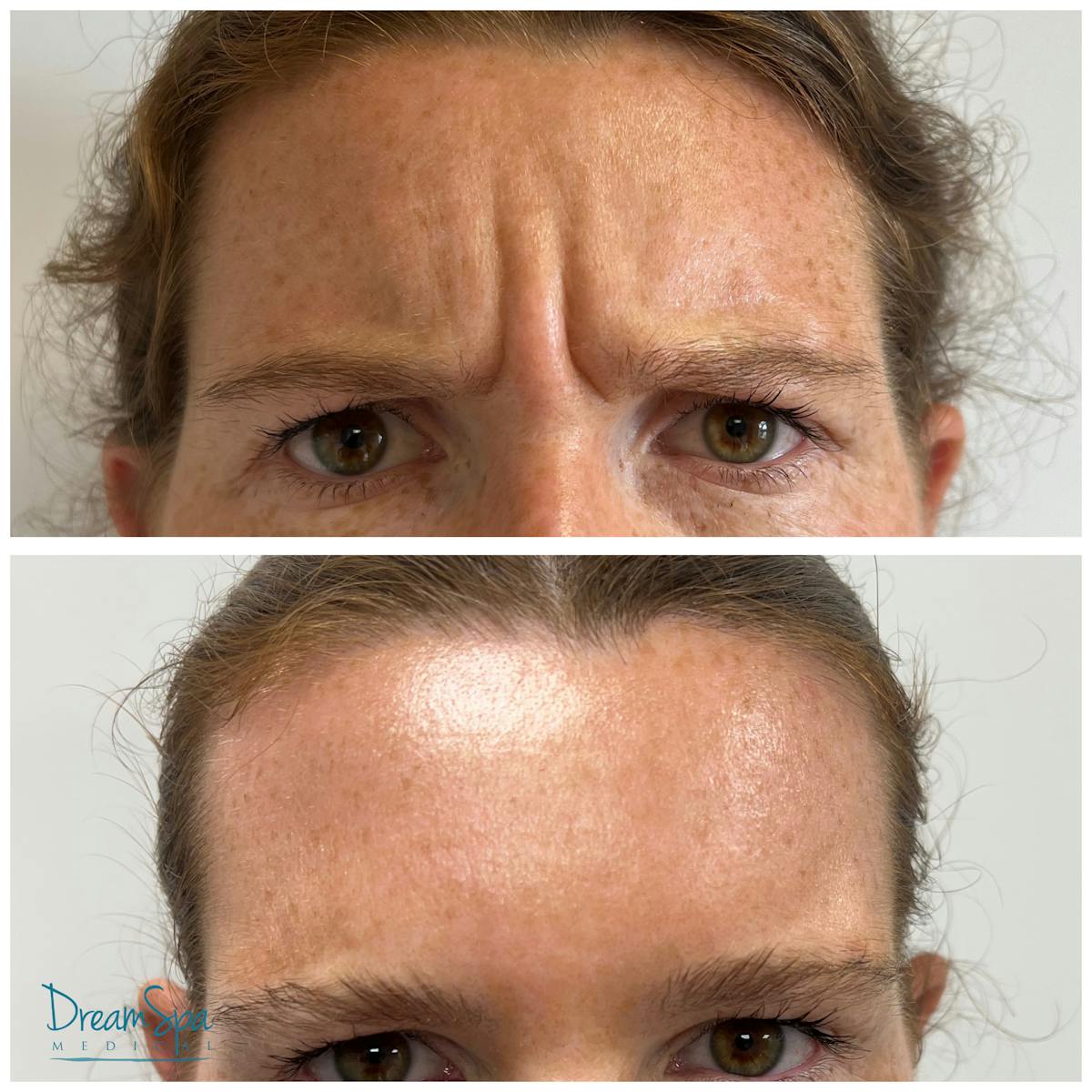 Botox Before & After Gallery - Patient 176513525 - Image 1