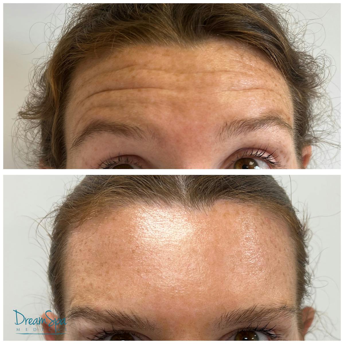 Botox Before & After Gallery - Patient 176513525 - Image 2