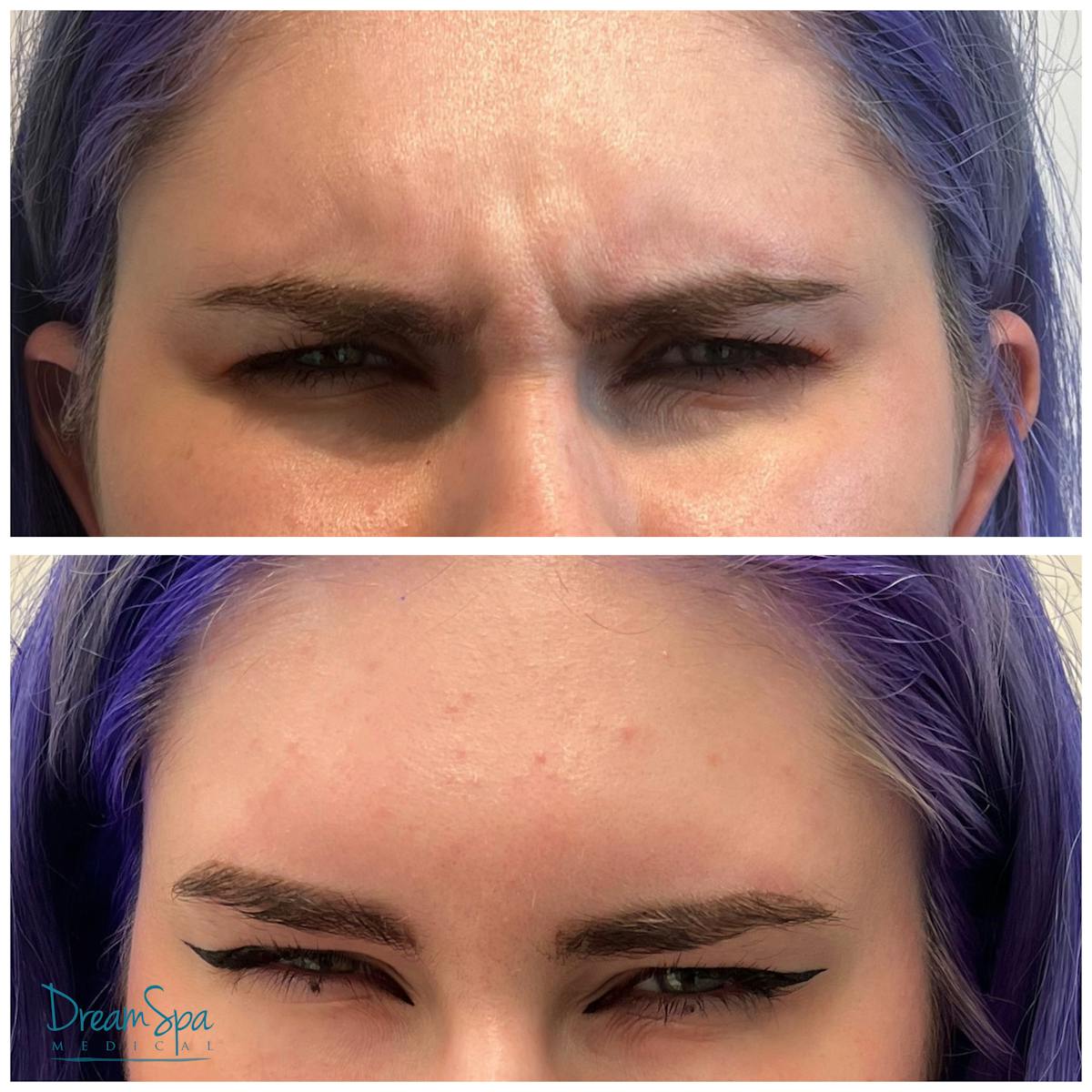 Botox Before & After Gallery - Patient 176513524 - Image 1