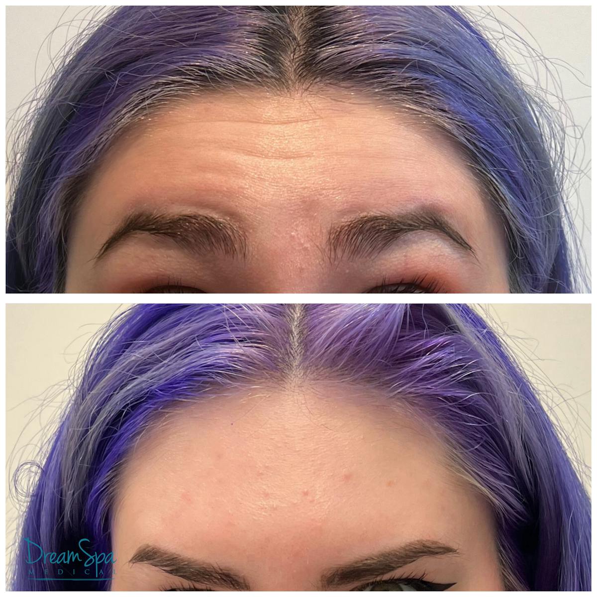 Botox Before & After Gallery - Patient 176513524 - Image 2