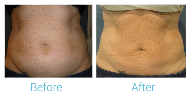 CoolSculpting