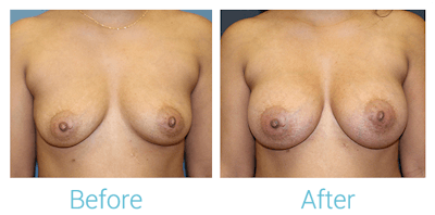 Breast Augmentation Before & After Gallery - Patient 58151779 - Image 1
