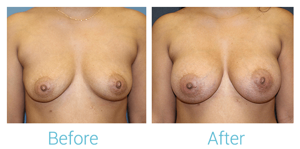 Breast Augmentation Before & After Gallery - Patient 58151779 - Image 1