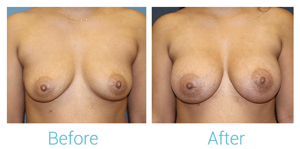 Breast Augmentation Gallery - Patient 58151779 - Image 1